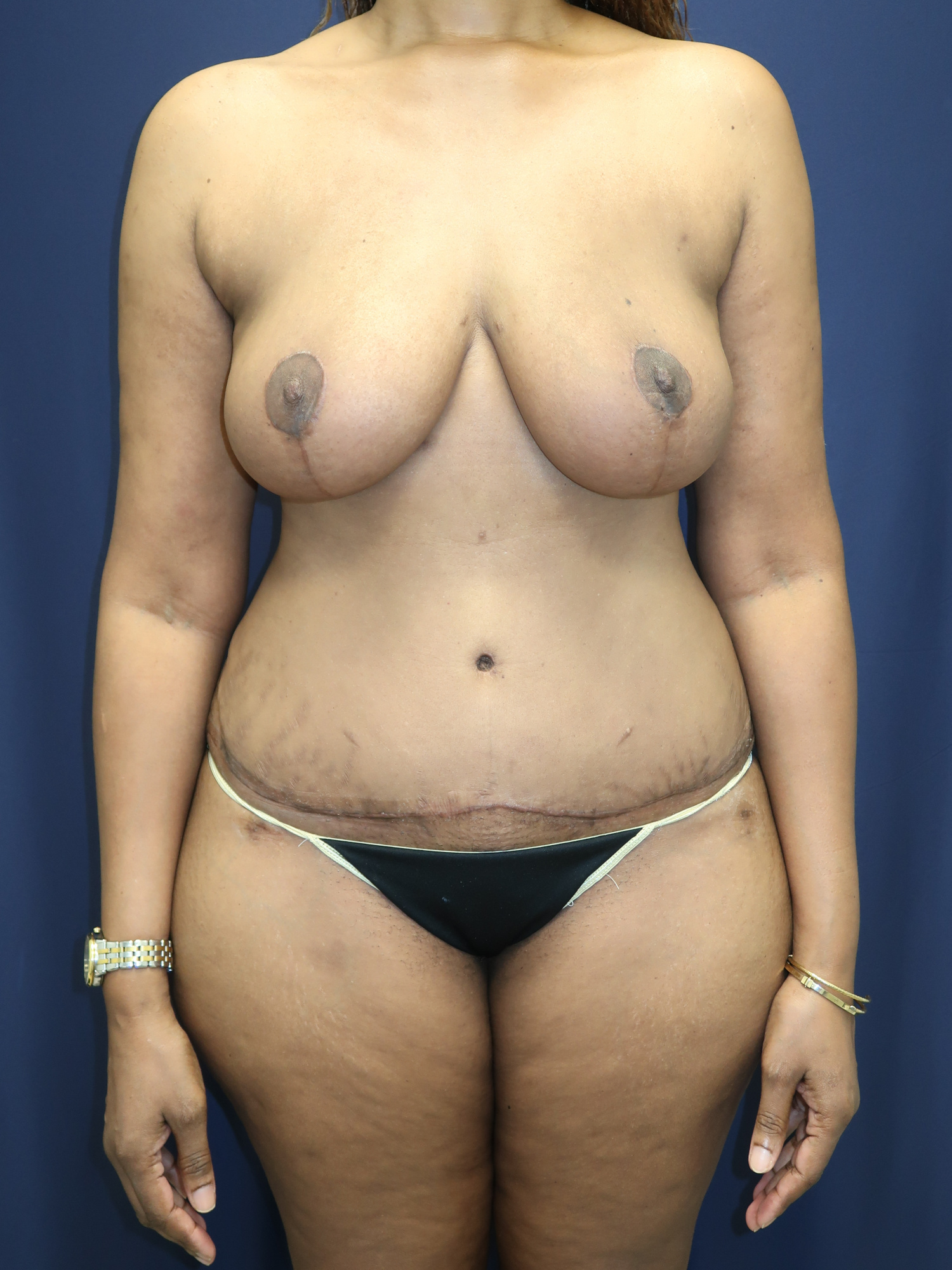 Abdominoplasty (Tummy Tuck) Patient Photo - Case 2985 - after view