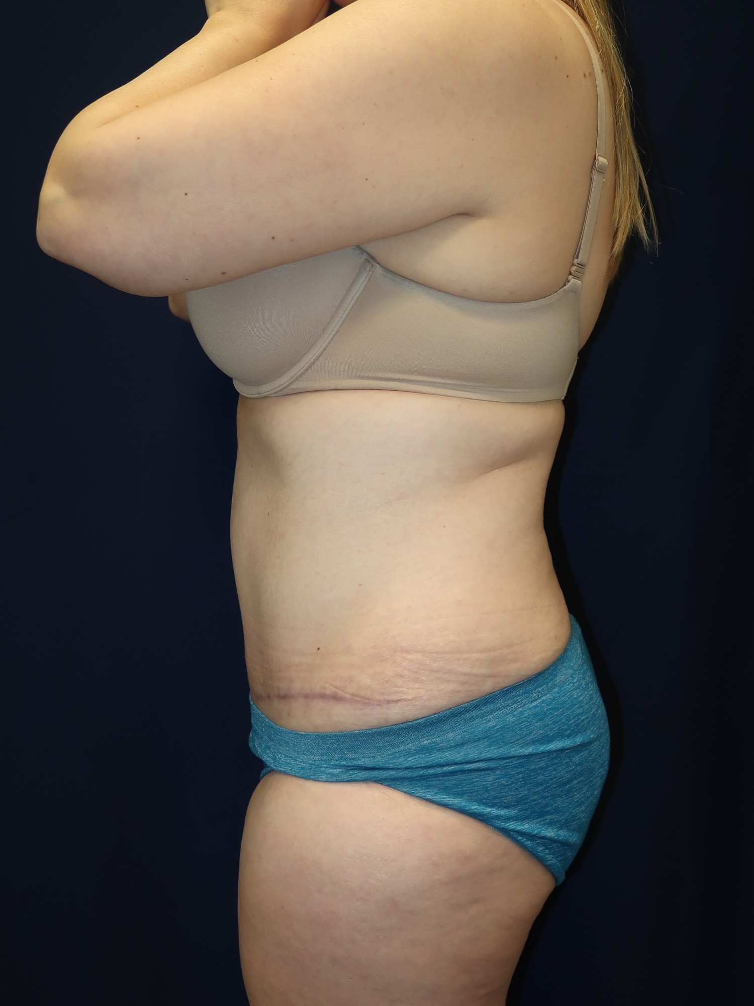 Abdominoplasty (Tummy Tuck) Patient Photo - Case 2993 - after view-2