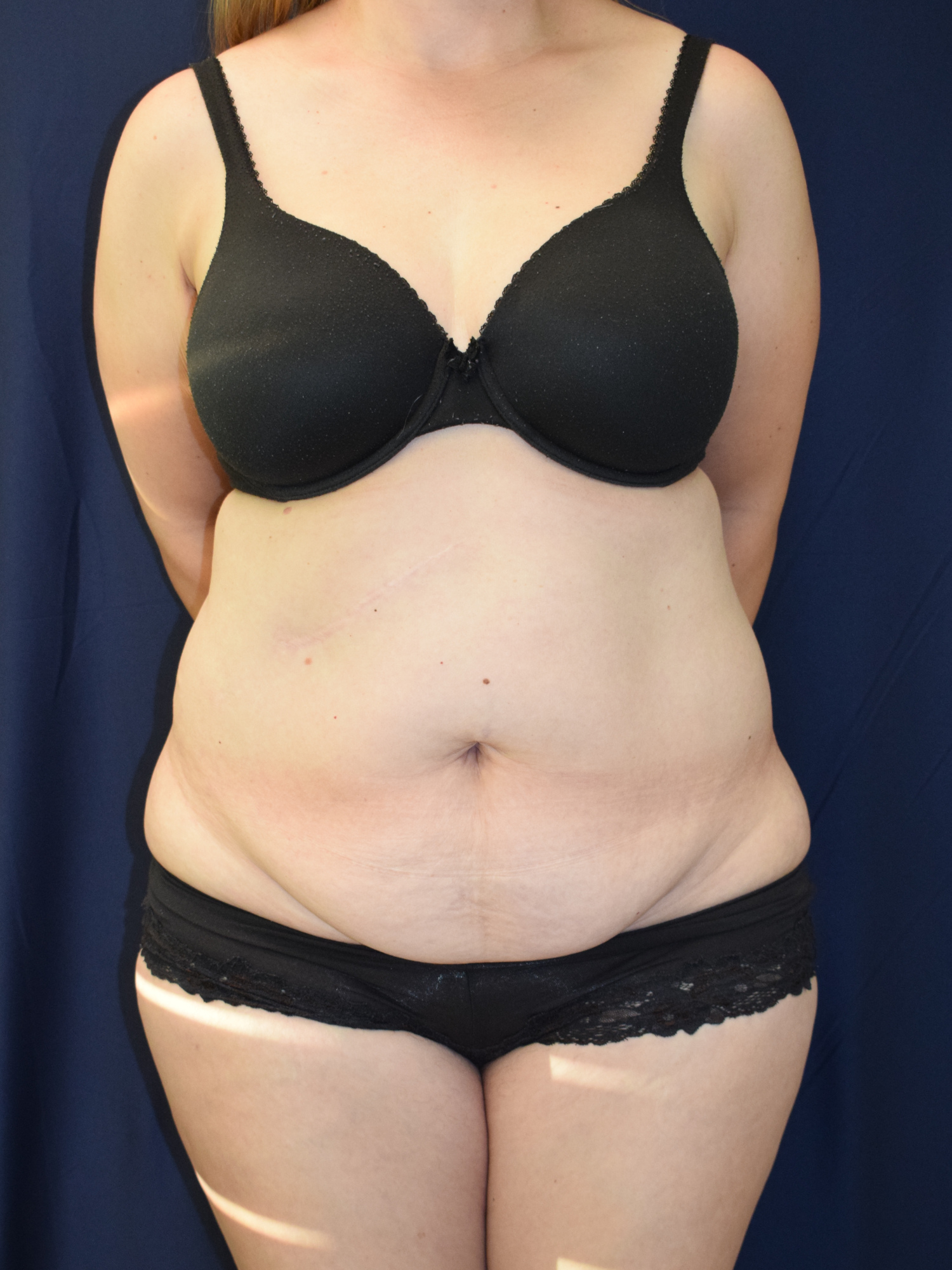 Abdominoplasty (Tummy Tuck) Patient Photo - Case 2993 - before view-