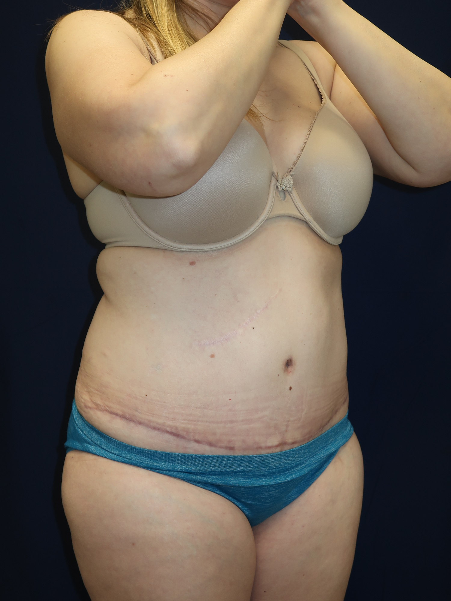 Abdominoplasty (Tummy Tuck) Patient Photo - Case 2993 - after view-1