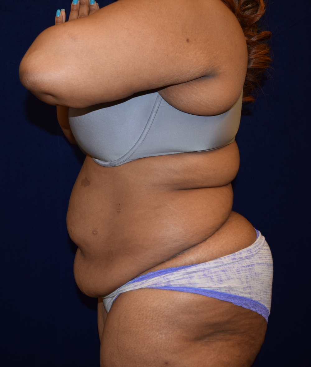 Abdominoplasty (Tummy Tuck) Patient Photo - Case 3676 - before view-2