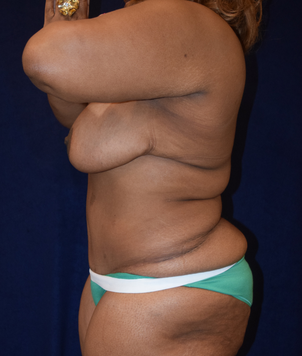 Abdominoplasty (Tummy Tuck) Patient Photo - Case 3676 - after view-2