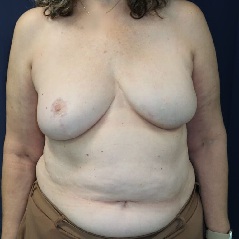 Breast Reconstruction - Case 3685 - After