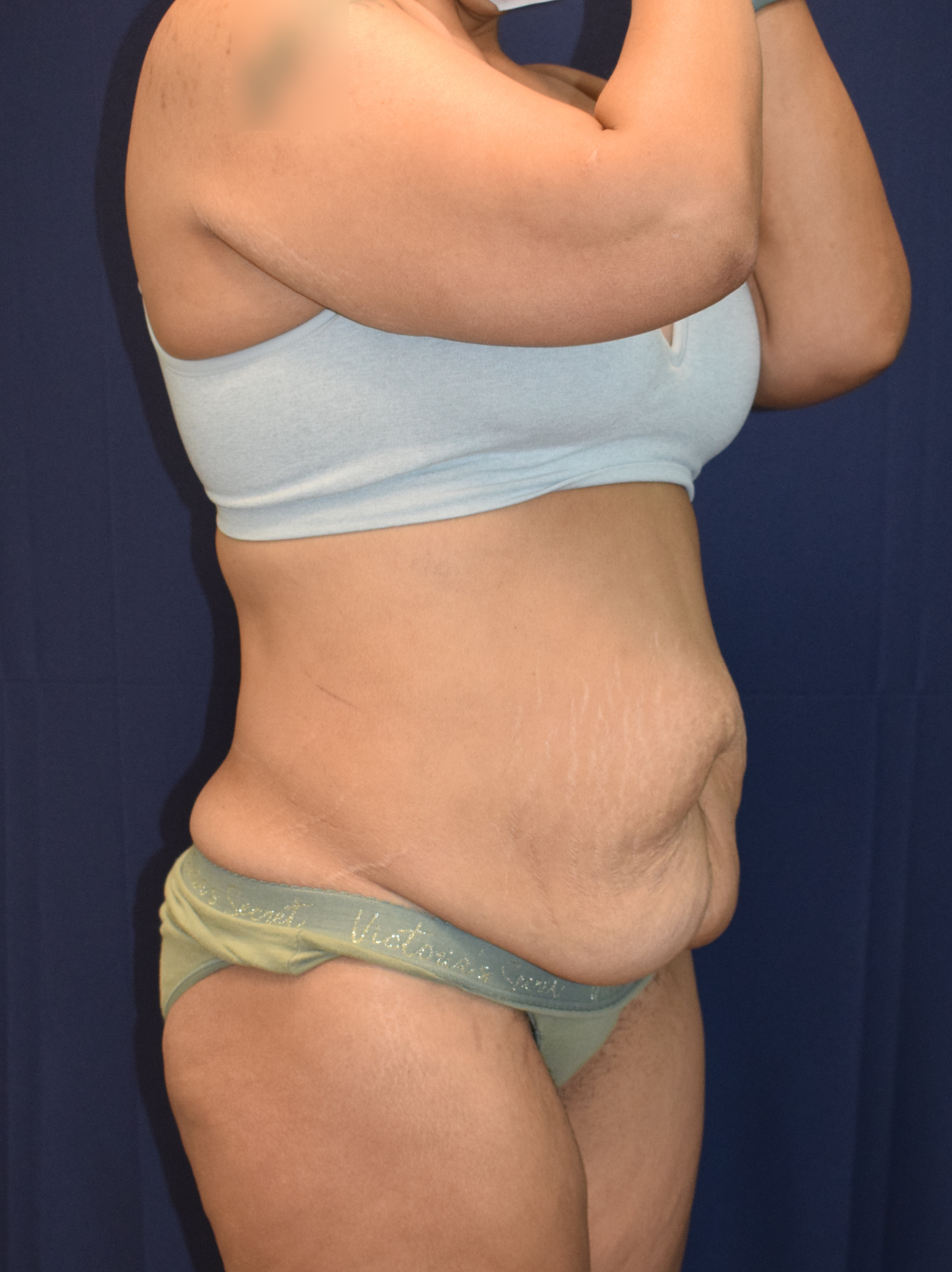 Abdominoplasty (Tummy Tuck) Patient Photo - Case 3705 - before view-2