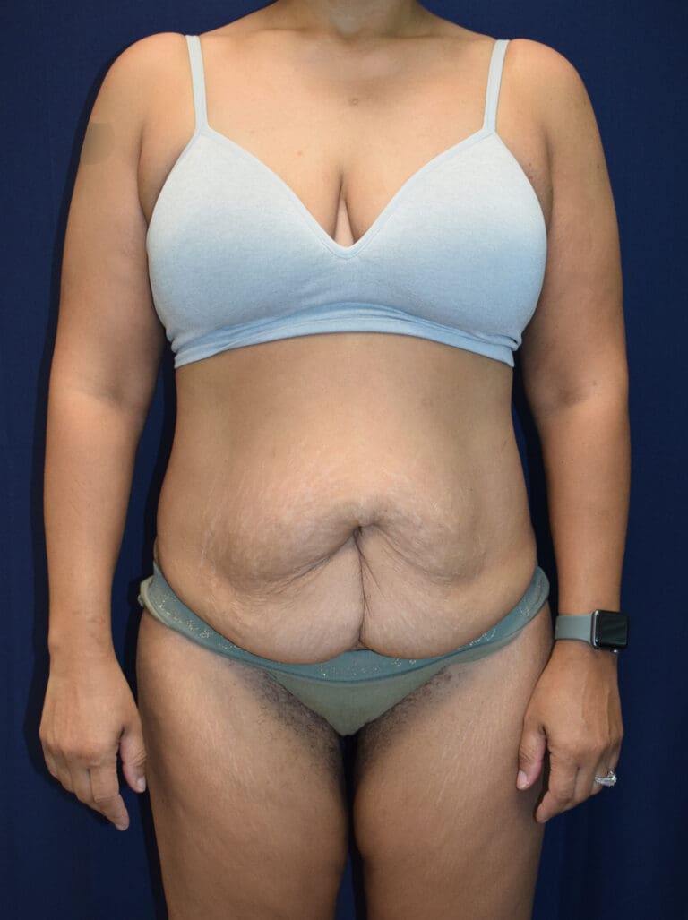 Abdominoplasty (Tummy Tuck) - Case 3705 - Before