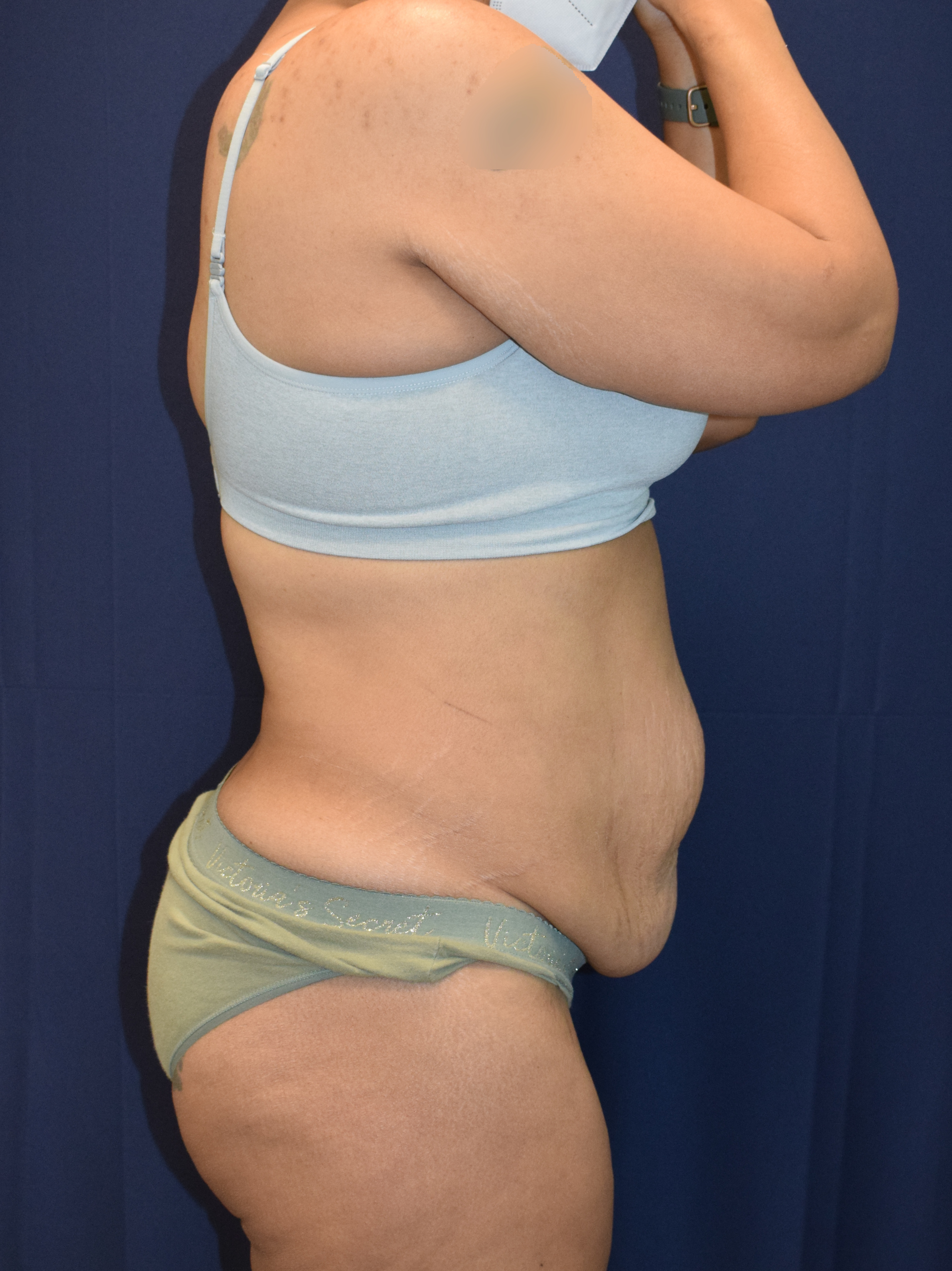 Abdominoplasty (Tummy Tuck) Patient Photo - Case 3705 - before view-4