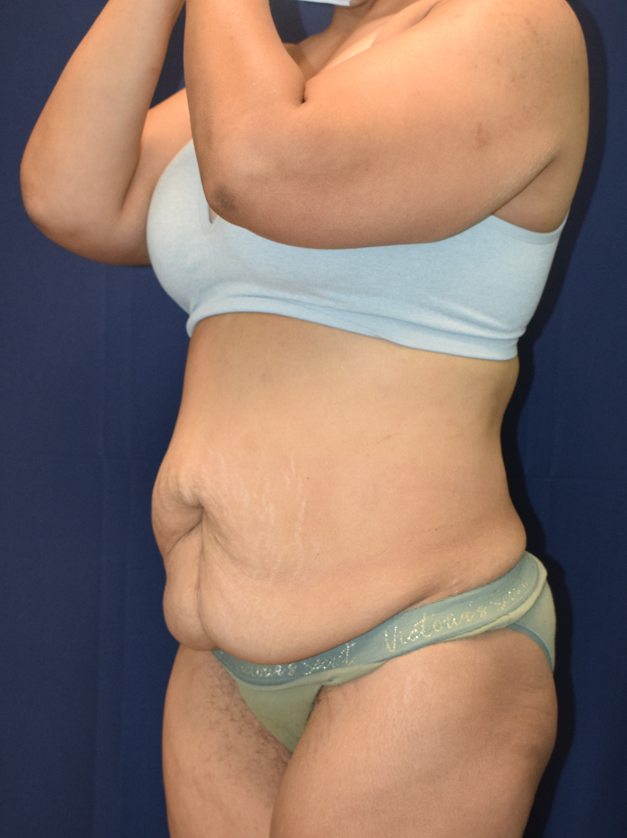 Abdominoplasty (Tummy Tuck) Patient Photo - Case 3705 - before view-1