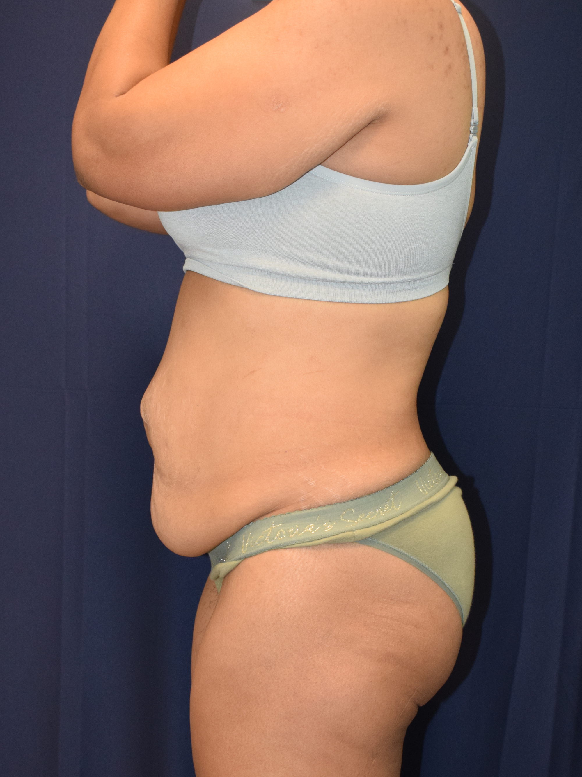 Abdominoplasty (Tummy Tuck) Patient Photo - Case 3705 - before view-3
