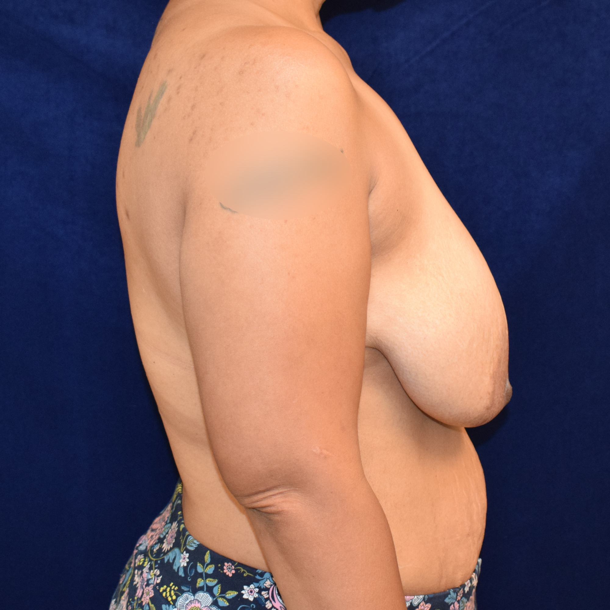Breast Lift Patient Photo - Case 3717 - before view-4