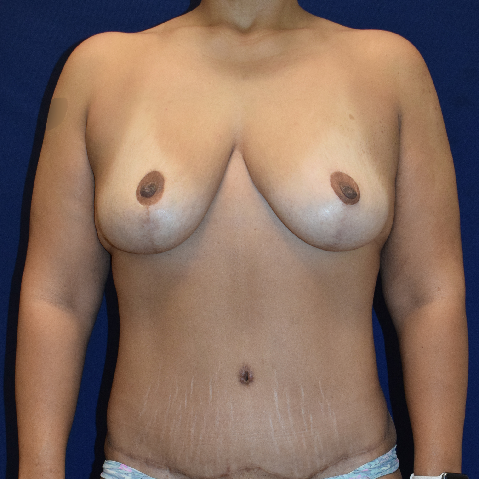 Breast Lift Patient Photo - Case 3717 - after view