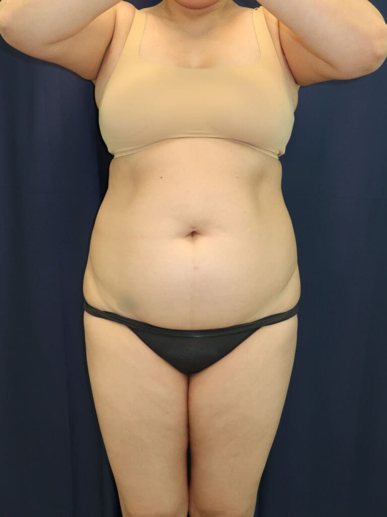 Abdominoplasty (Tummy Tuck) - Case 3743 - Before