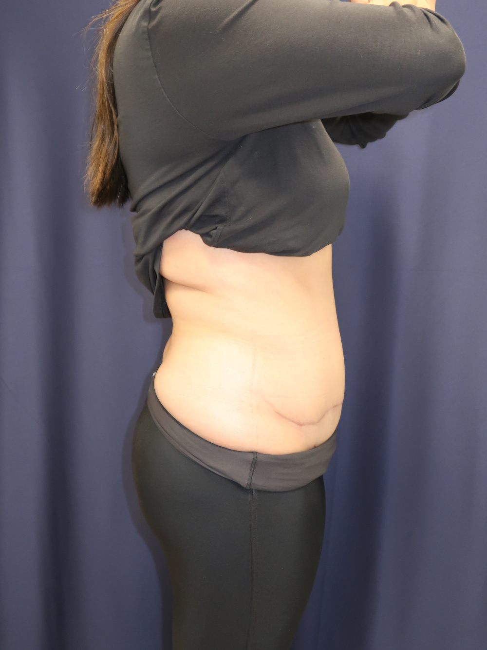 Abdominoplasty (Tummy Tuck) Patient Photo - Case 3743 - after view-2