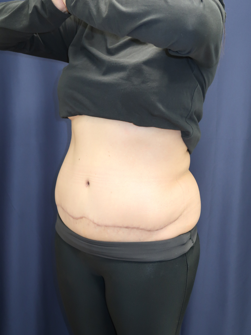 Abdominoplasty (Tummy Tuck) Patient Photo - Case 3743 - after view-1