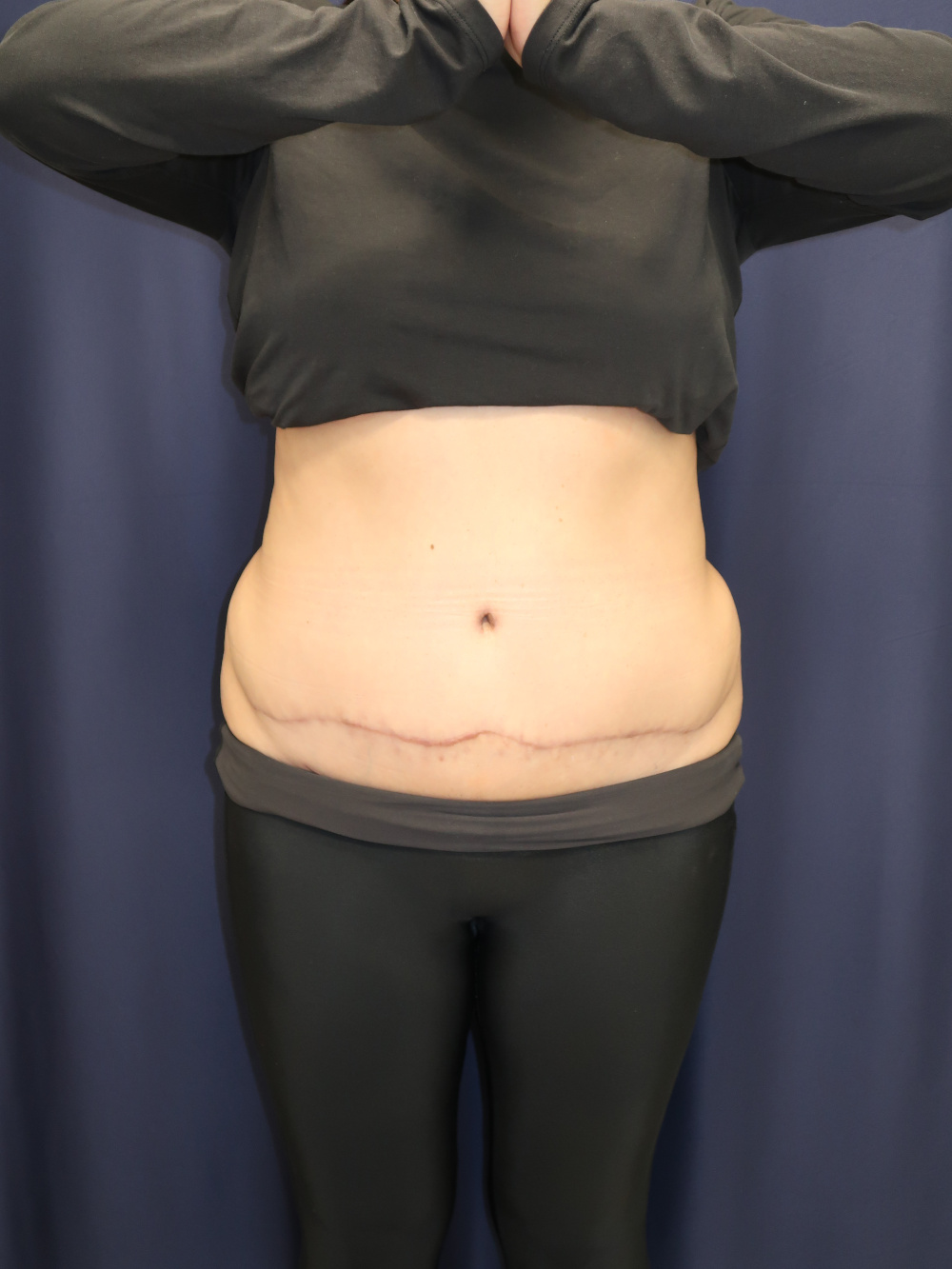 Abdominoplasty Patient Photo - Case 3743 - after view