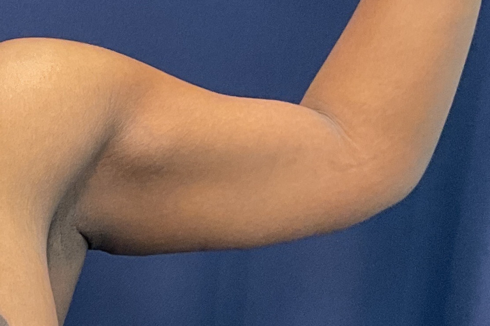 Arm Lift Patient Photo - Case 3891 - after view-1