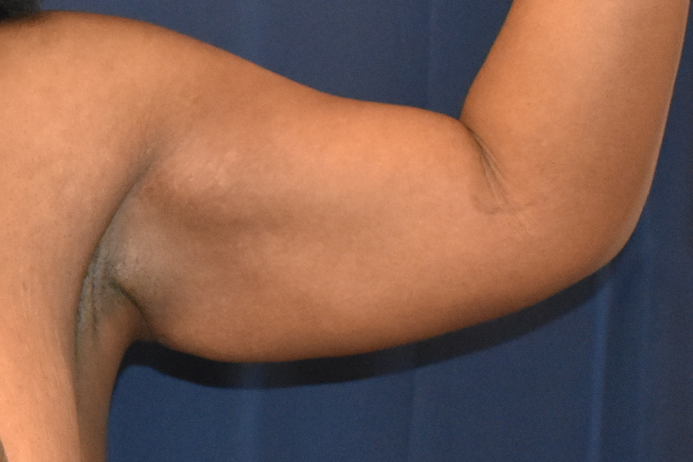 Arm Lift Patient Photo - Case 3891 - before view-1