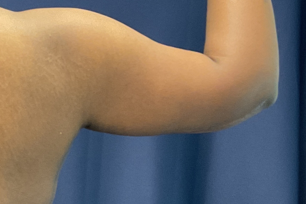 Arm Lift Patient Photo - Case 3891 - after view-3