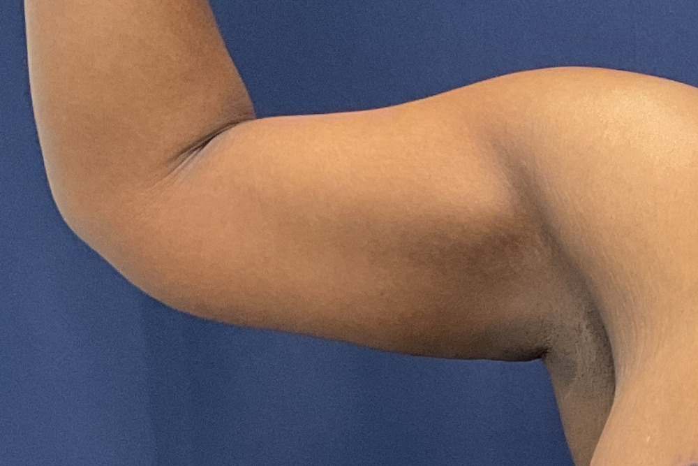 Arm Lift Patient Photo - Case 3891 - after view