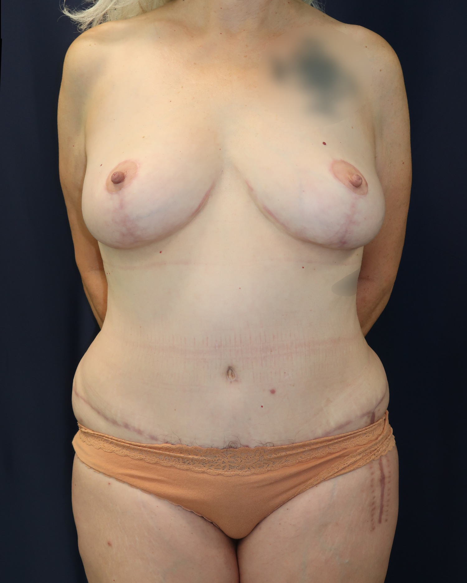 Abdominoplasty (Tummy Tuck) Patient Photo - Case 3909 - after view
