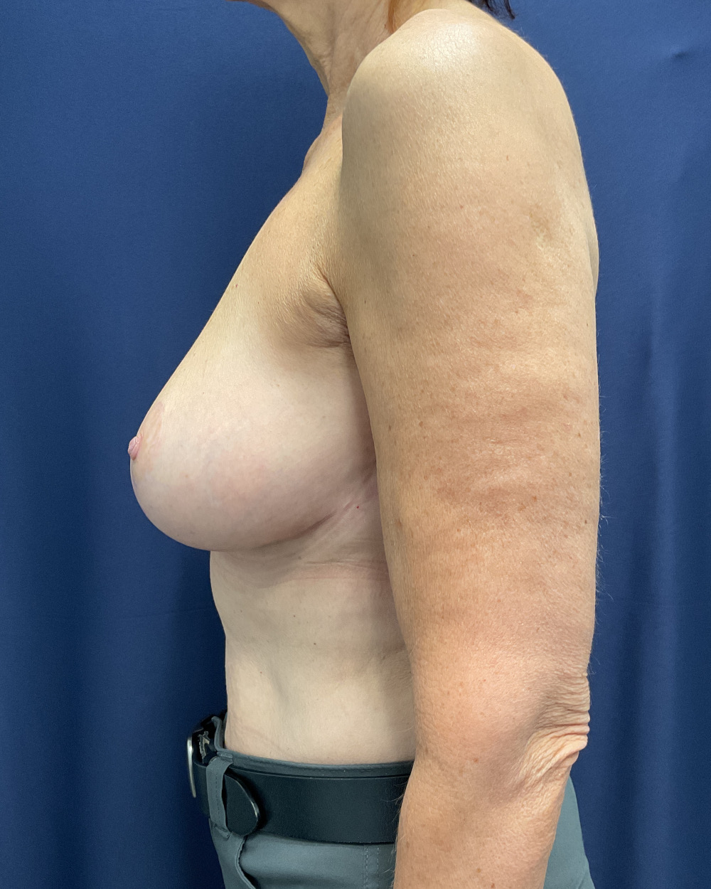 Breast Lift Patient Photo - Case 4288 - after view-4