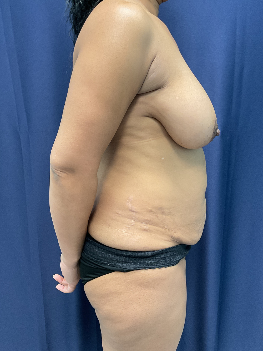 Abdominoplasty Patient Photo - Case 4431 - before view-4