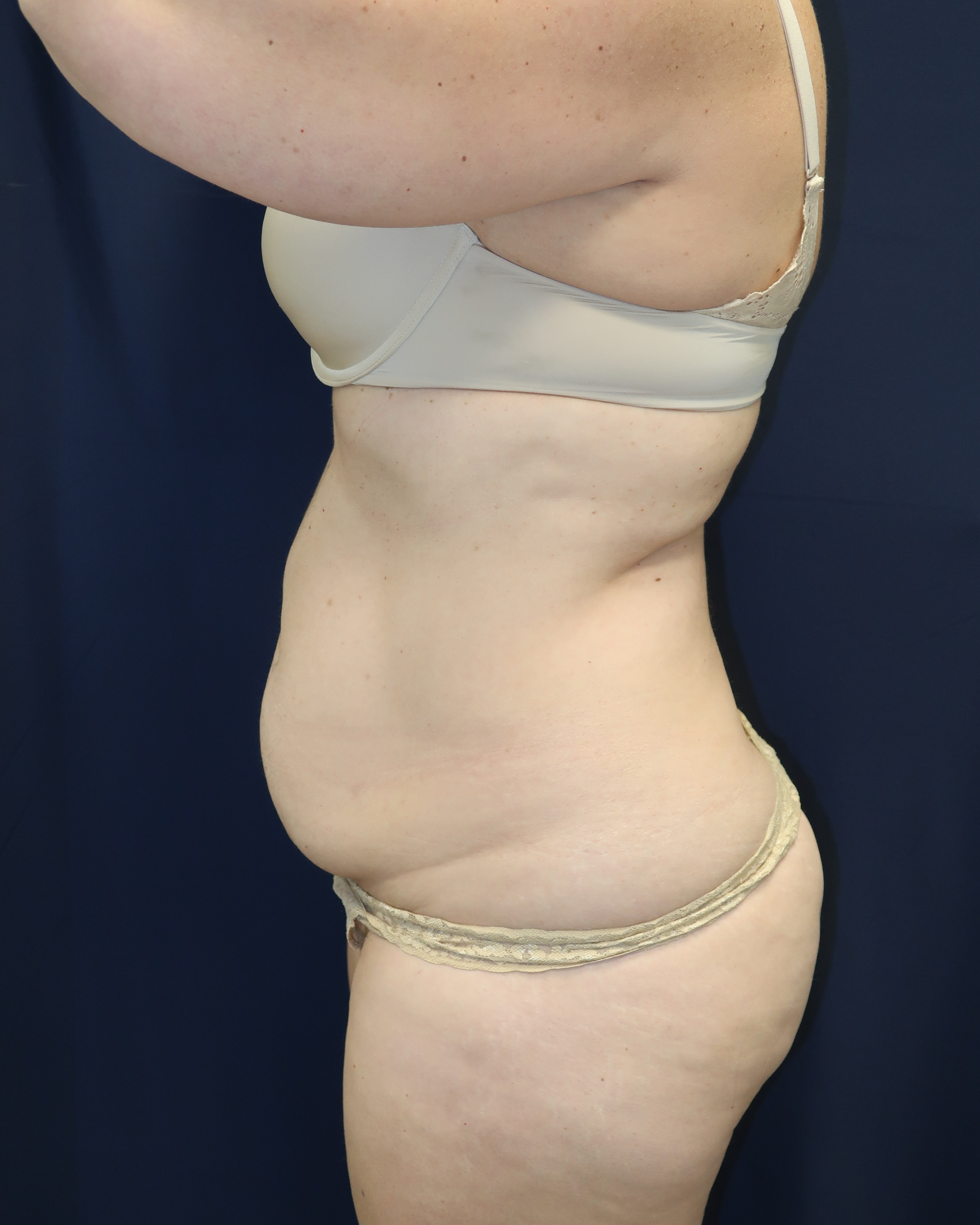 Abdominoplasty Patient Photo - Case 4467 - before view-4