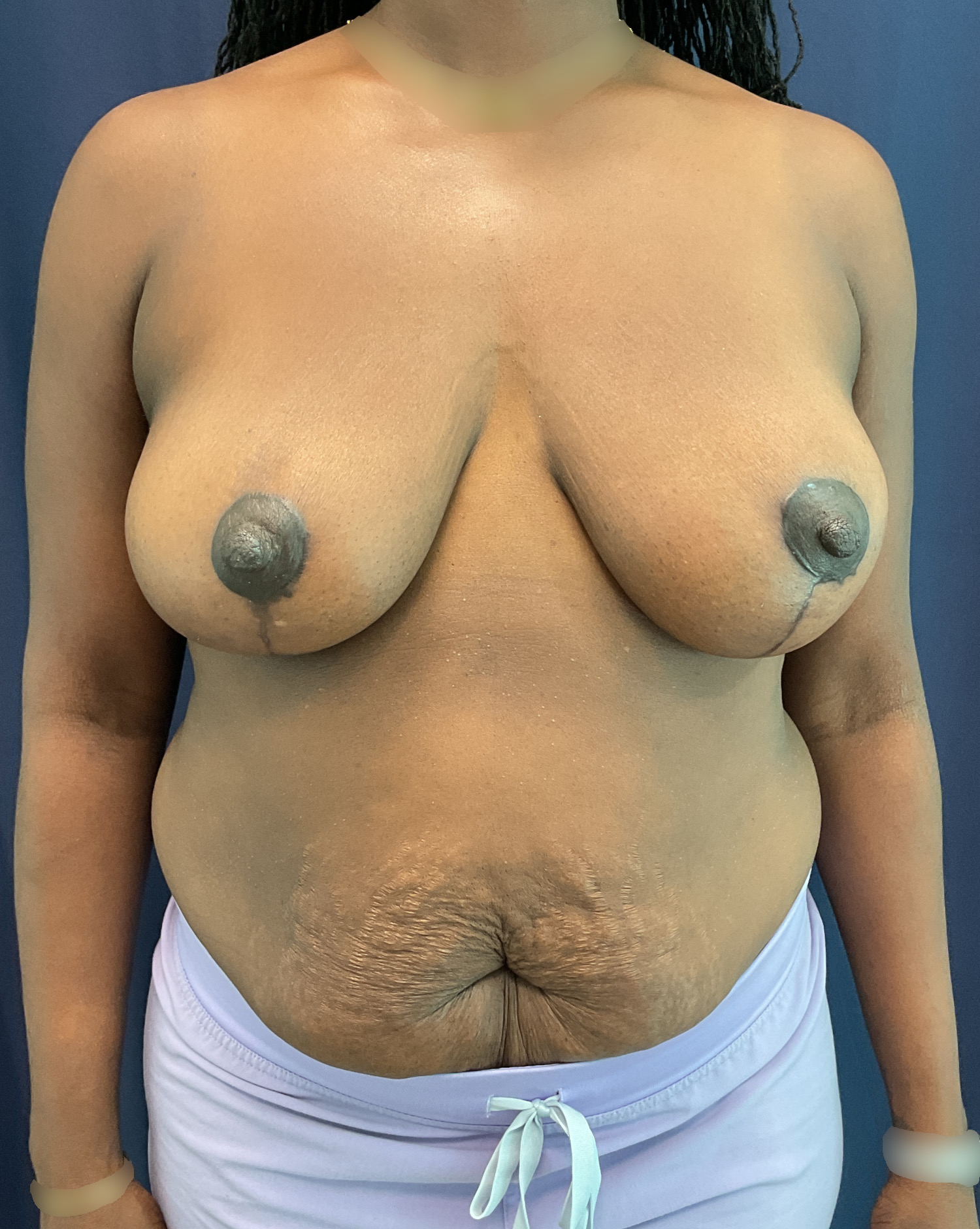 Breast Lift Patient Photo - Case 4621 - after view