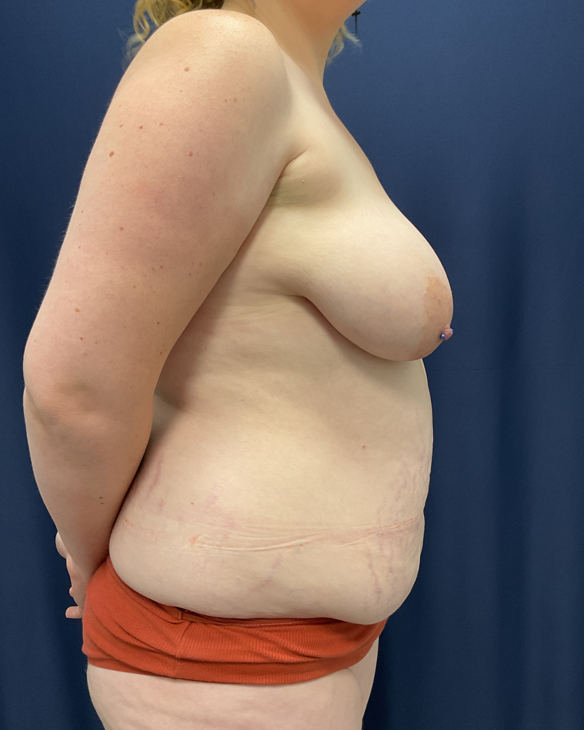 Abdominoplasty Patient Photo - Case 4663 - before view-1