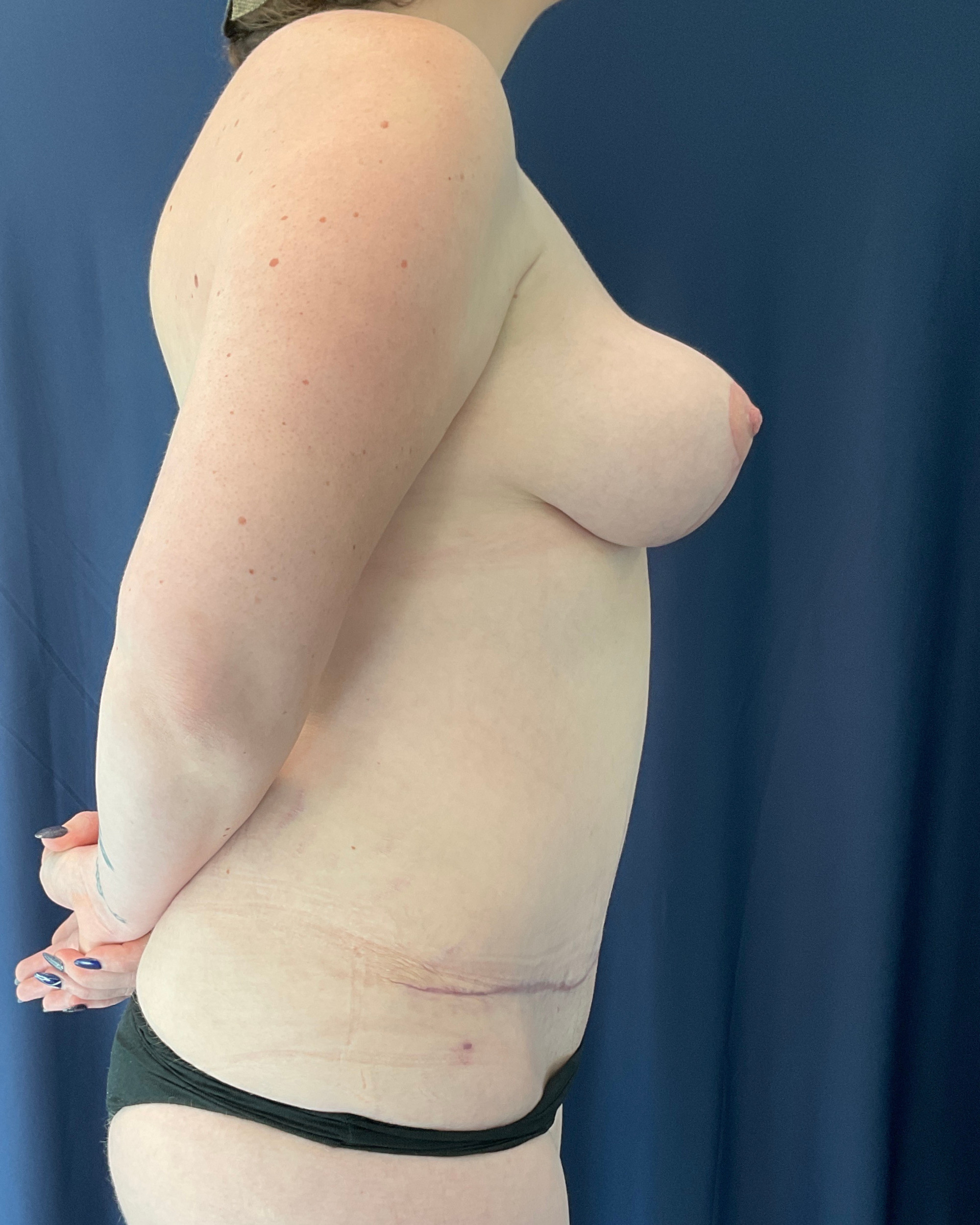 Abdominoplasty Patient Photo - Case 4663 - after view-1