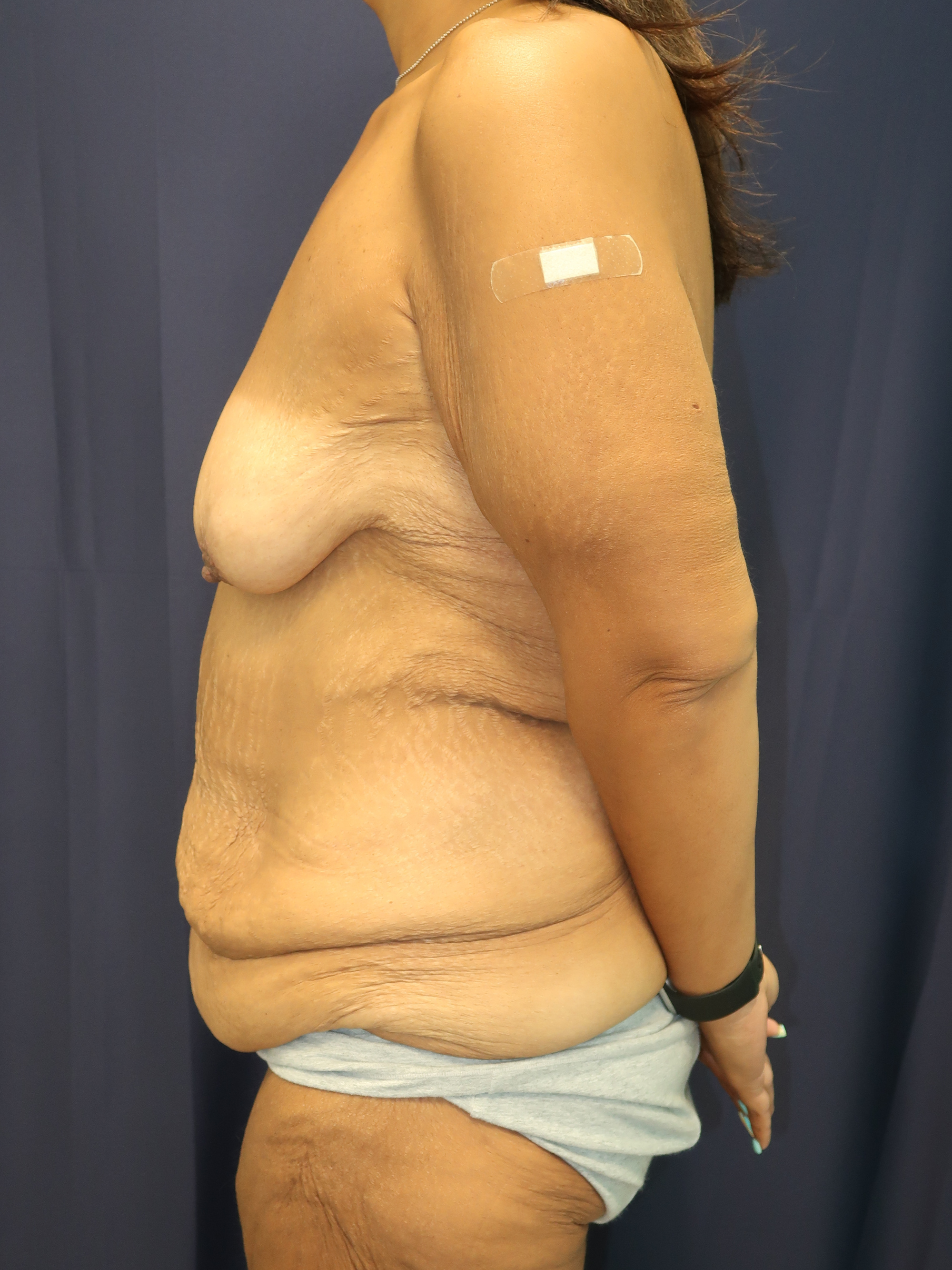 Breast Augmentation Patient Photo - Case 4704 - before view-3