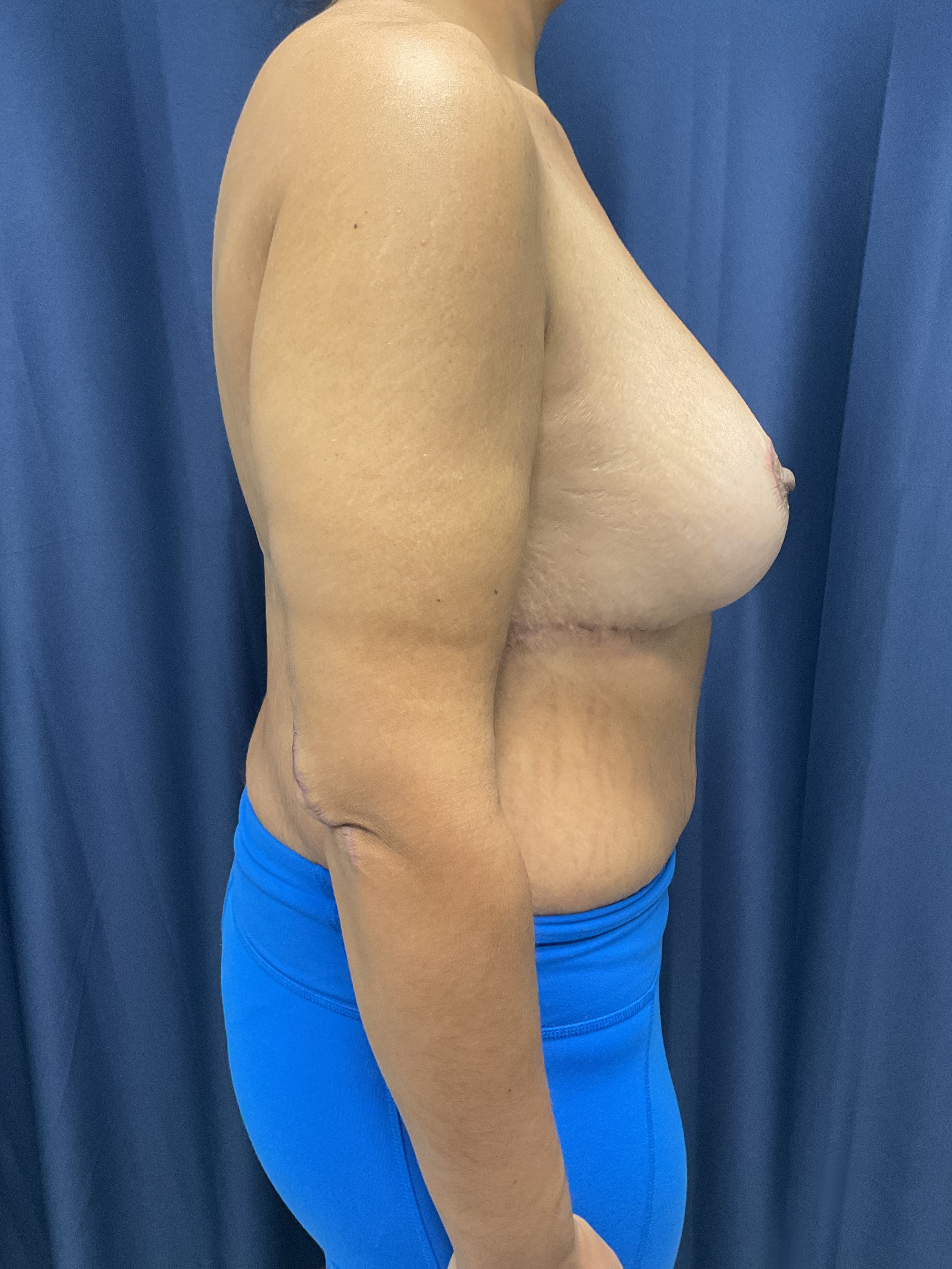 Breast Augmentation Patient Photo - Case 4704 - after view-2