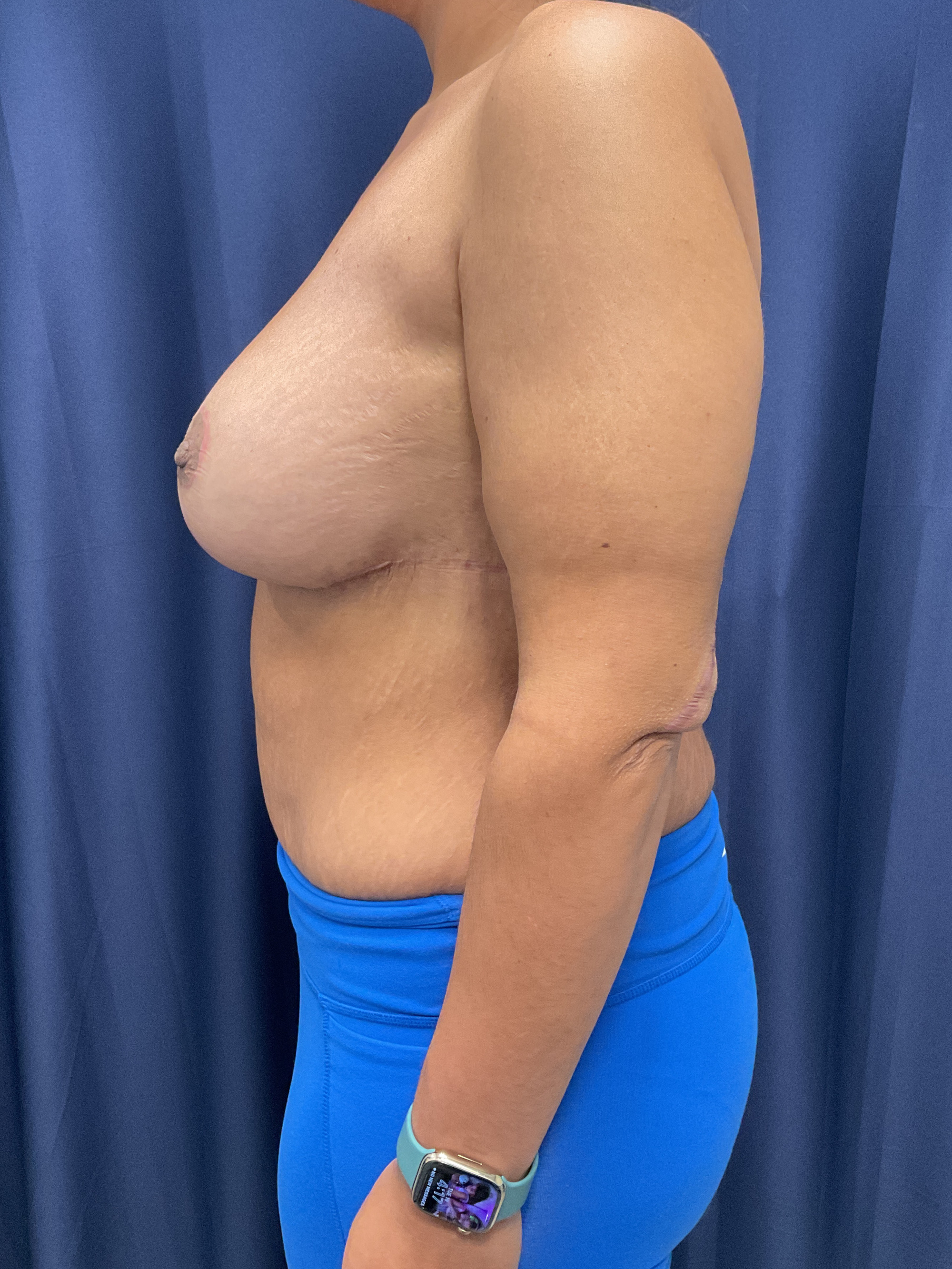 Breast Augmentation Patient Photo - Case 4704 - after view-3