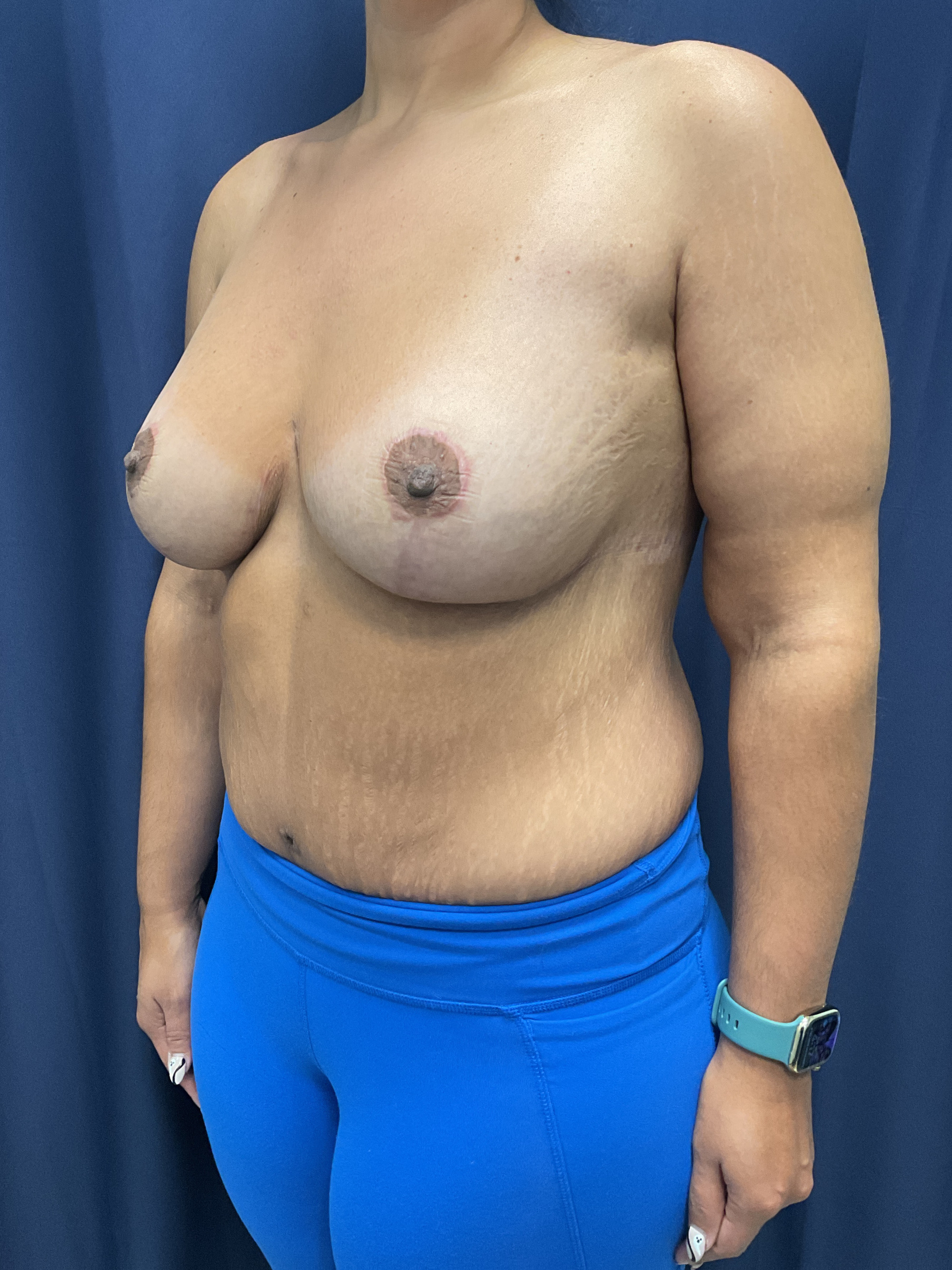 Breast Augmentation Patient Photo - Case 4704 - after view-1