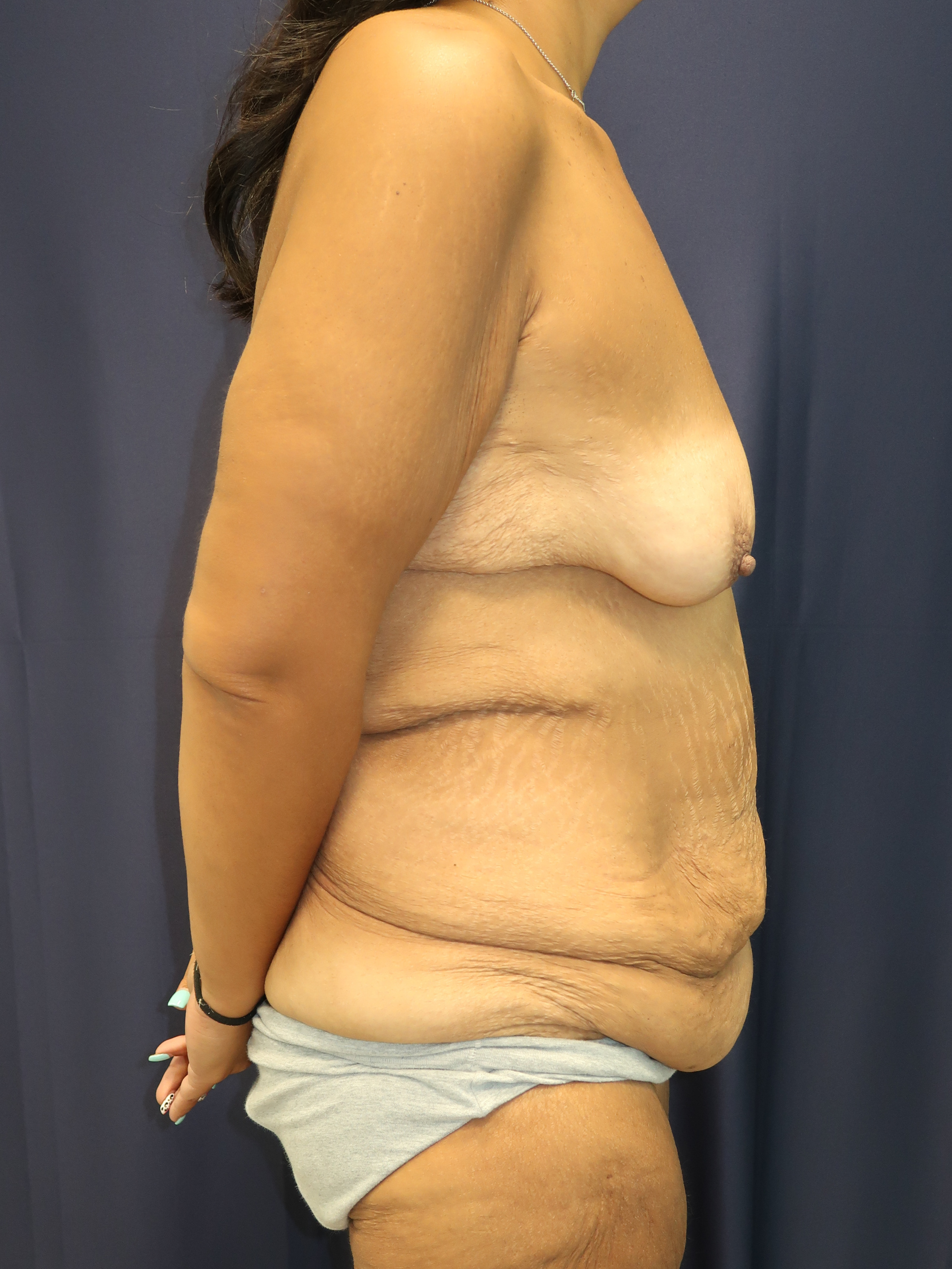 Breast Augmentation Patient Photo - Case 4704 - before view-2