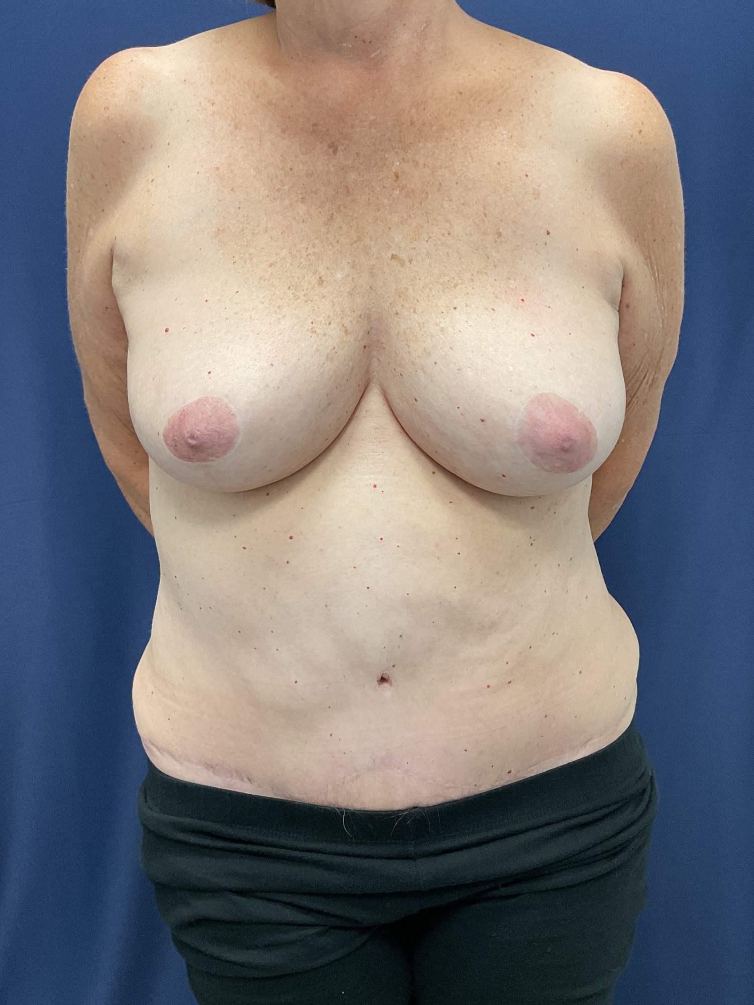 Abdominoplasty Patient Photo - Case 4719 - after view-1