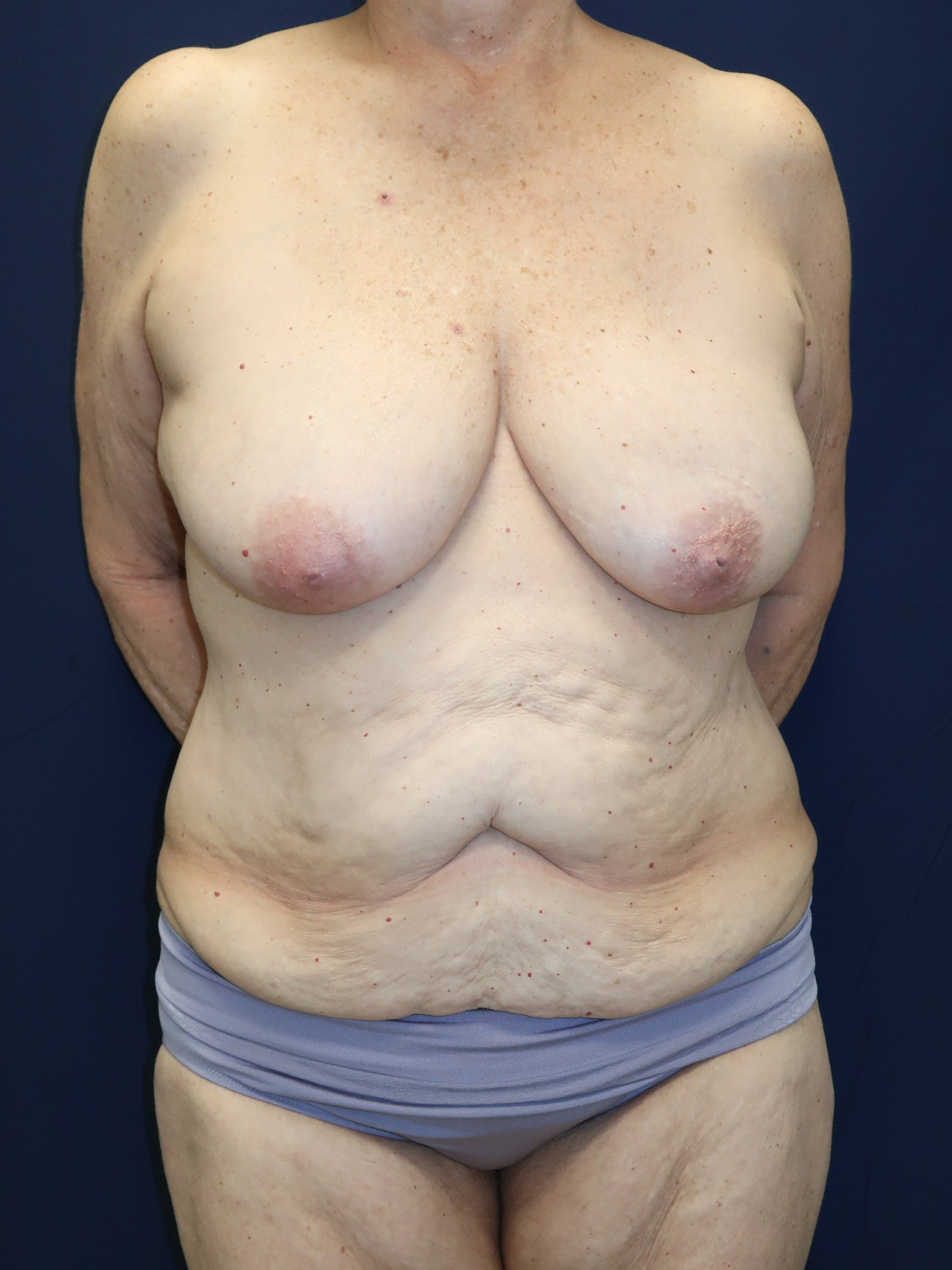 Abdominoplasty Patient Photo - Case 4719 - before view-1
