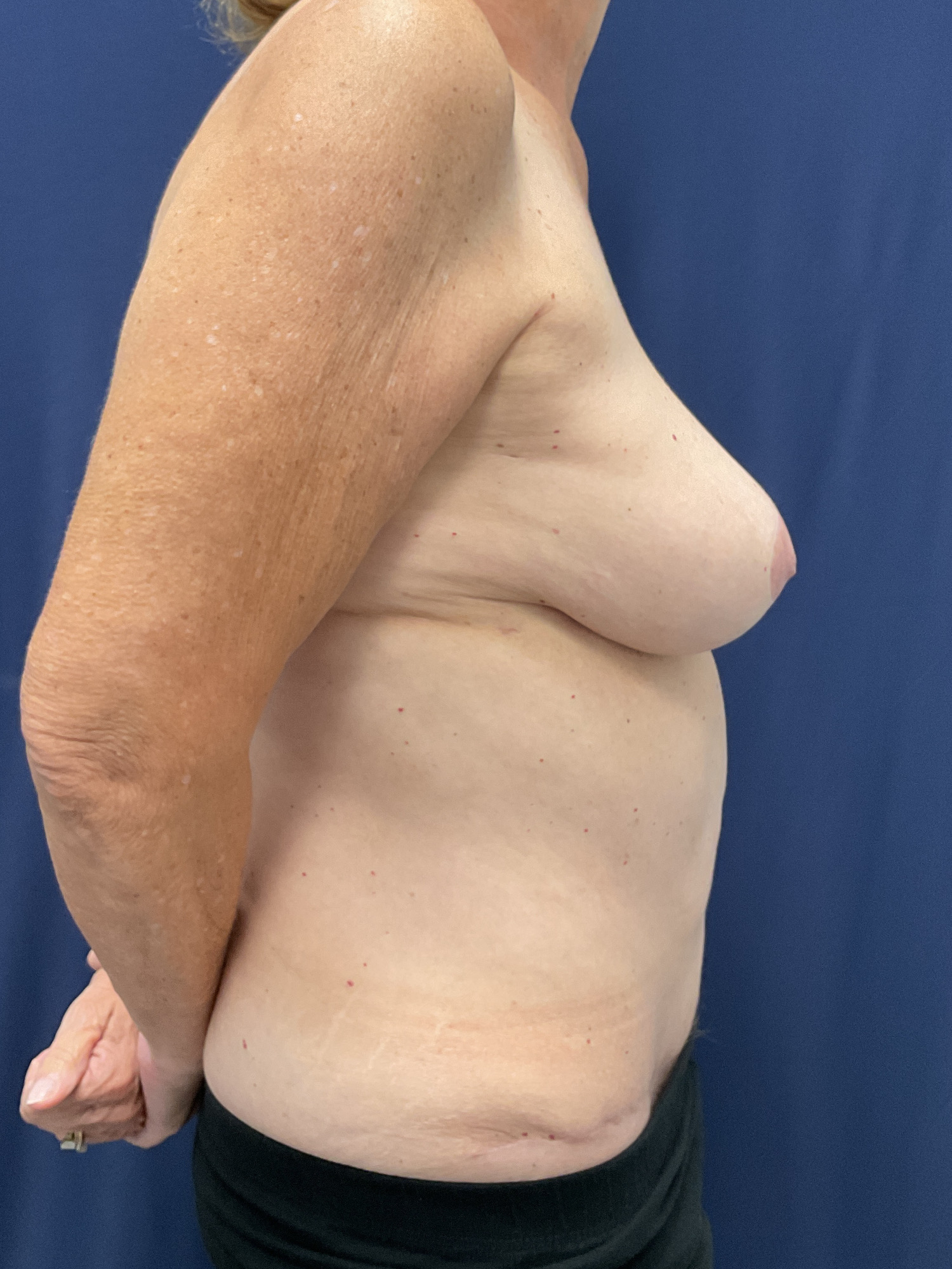 Abdominoplasty Patient Photo - Case 4719 - after view-3