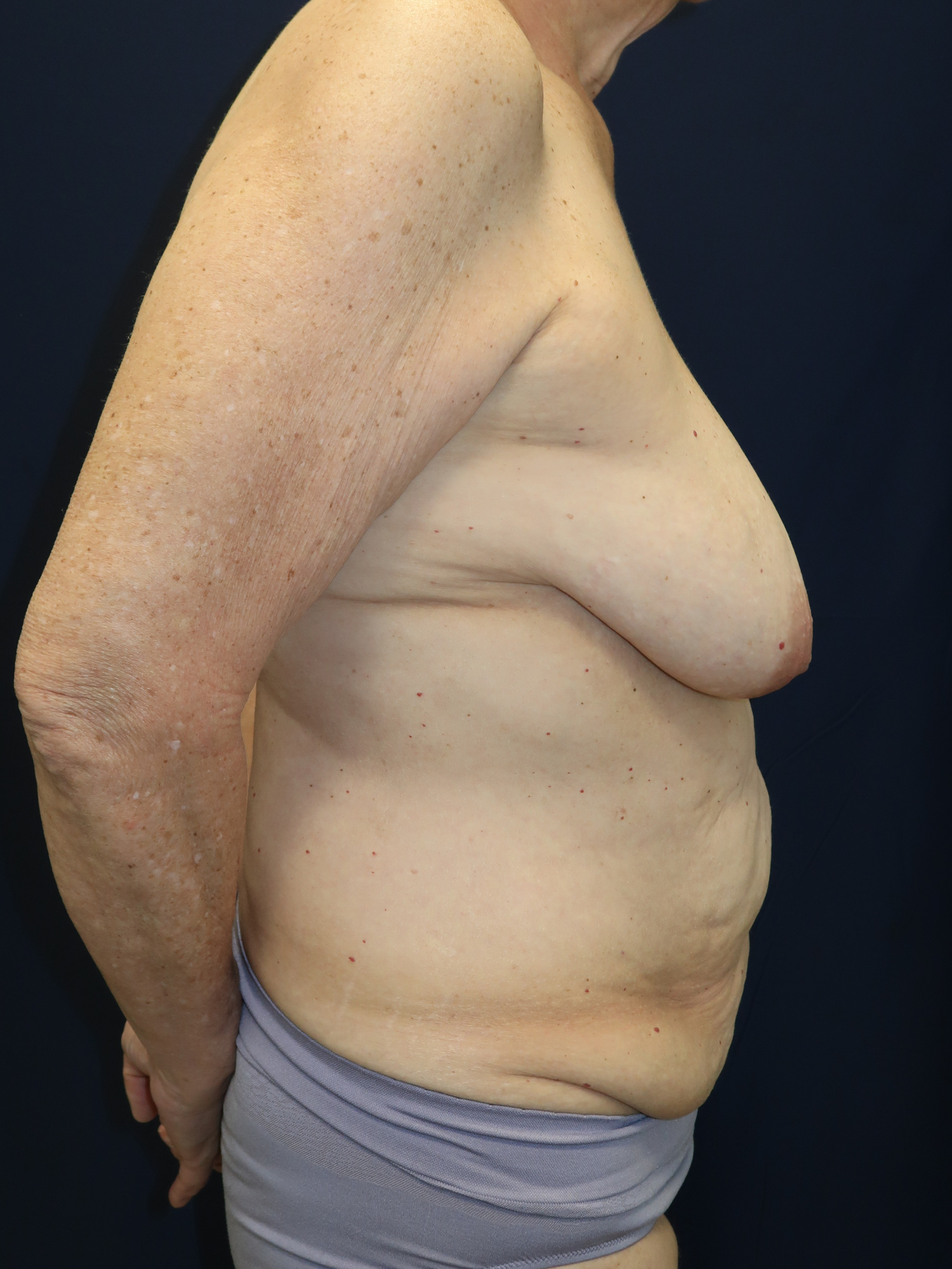 Abdominoplasty Patient Photo - Case 4719 - before view-3