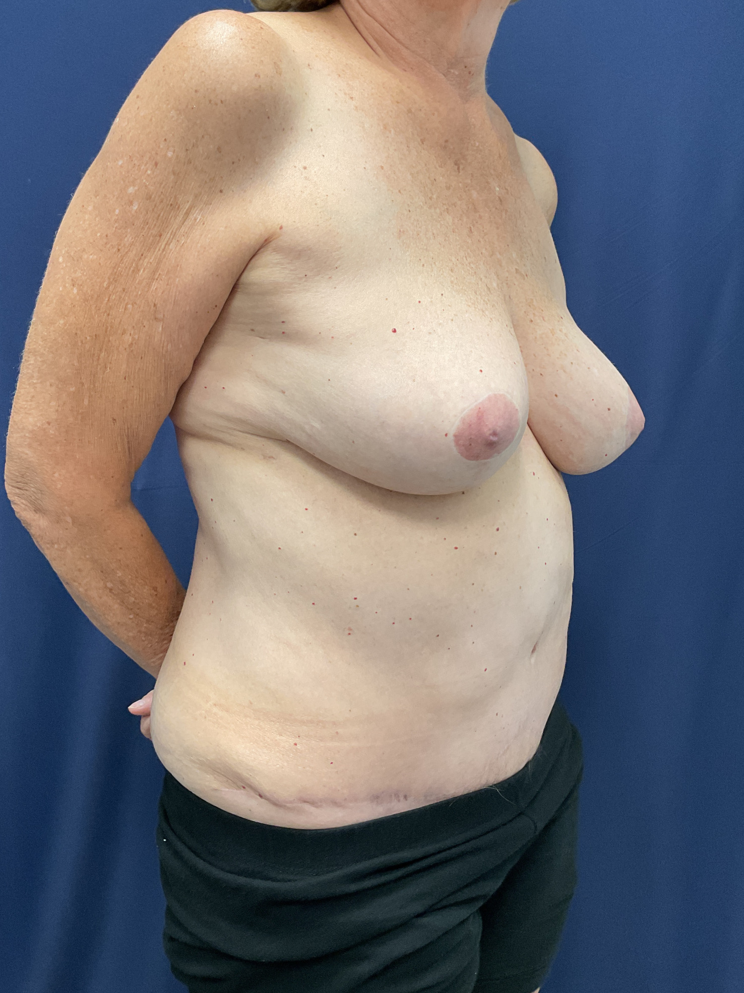 Abdominoplasty Patient Photo - Case 4719 - after view-2