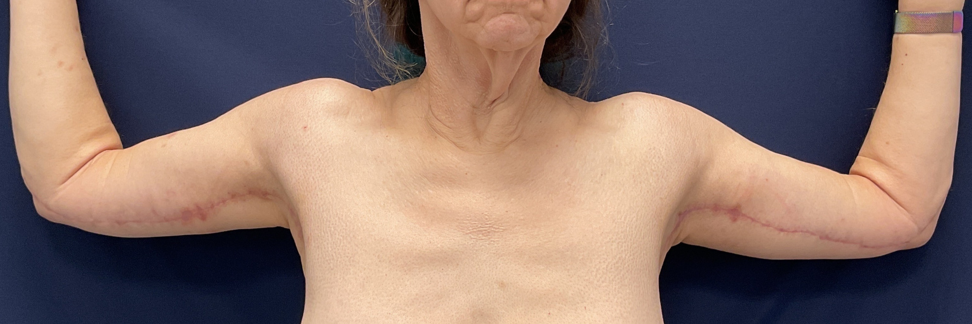 Arm Lift Patient Photo - Case 4859 - after view-1