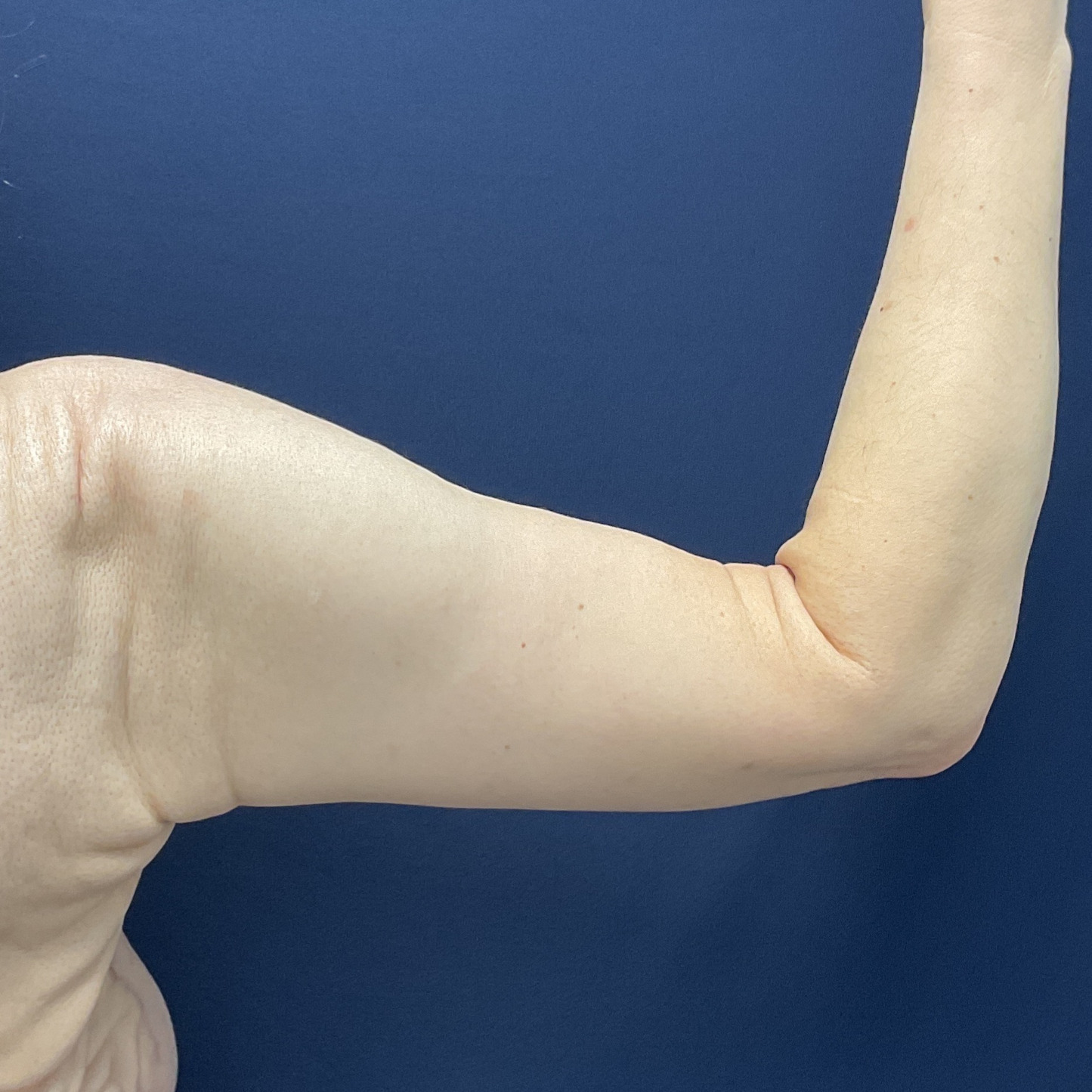 Arm Lift Patient Photo - Case 4859 - after view