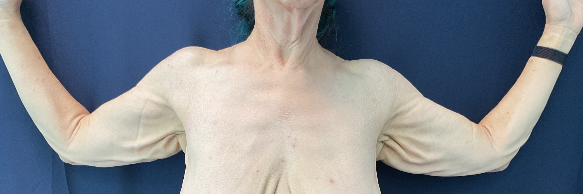 Arm Lift Patient Photo - Case 4859 - before view-1