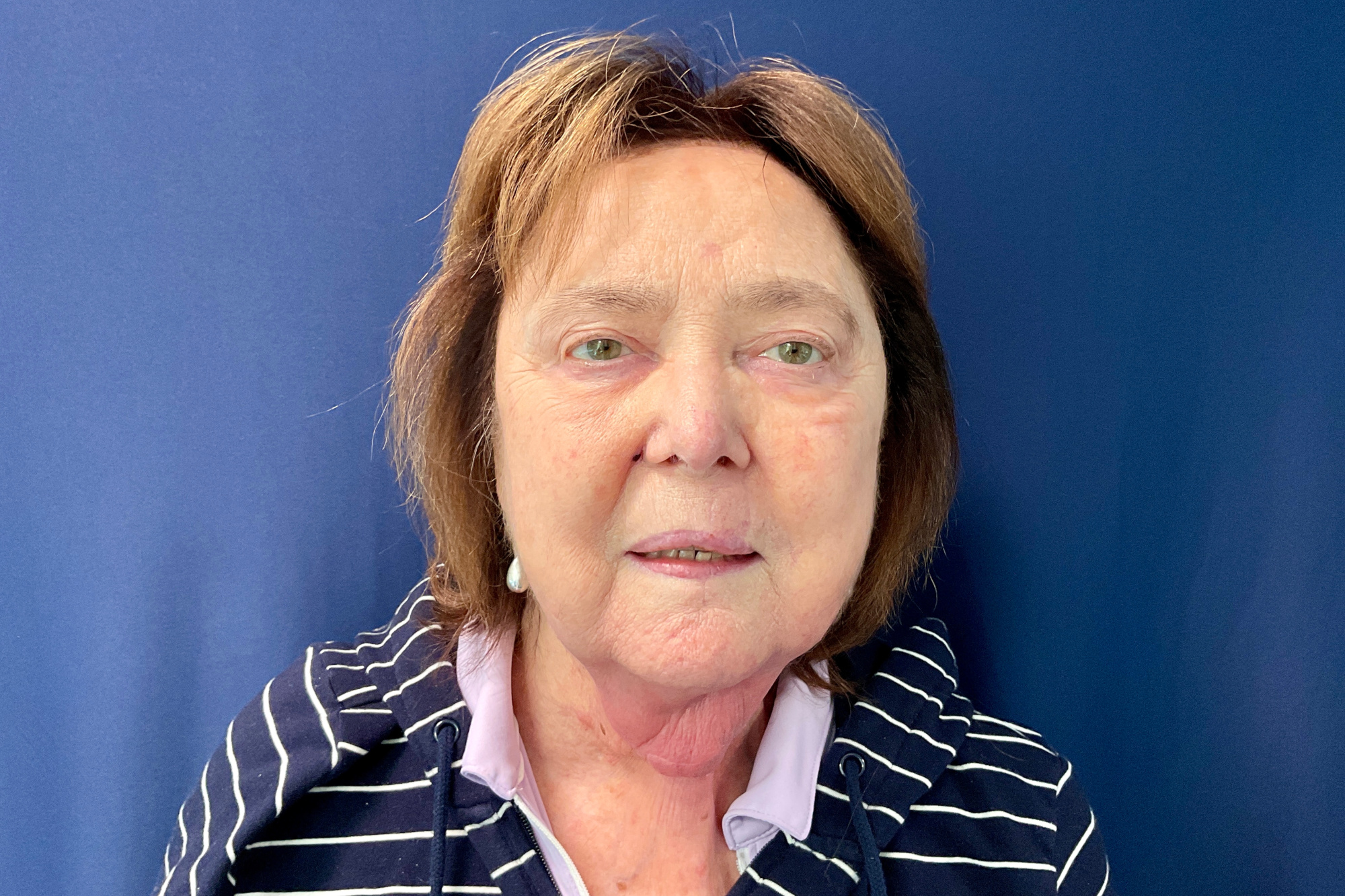 Mohs Reconstruction Patient Photo - Case 4868 - after view