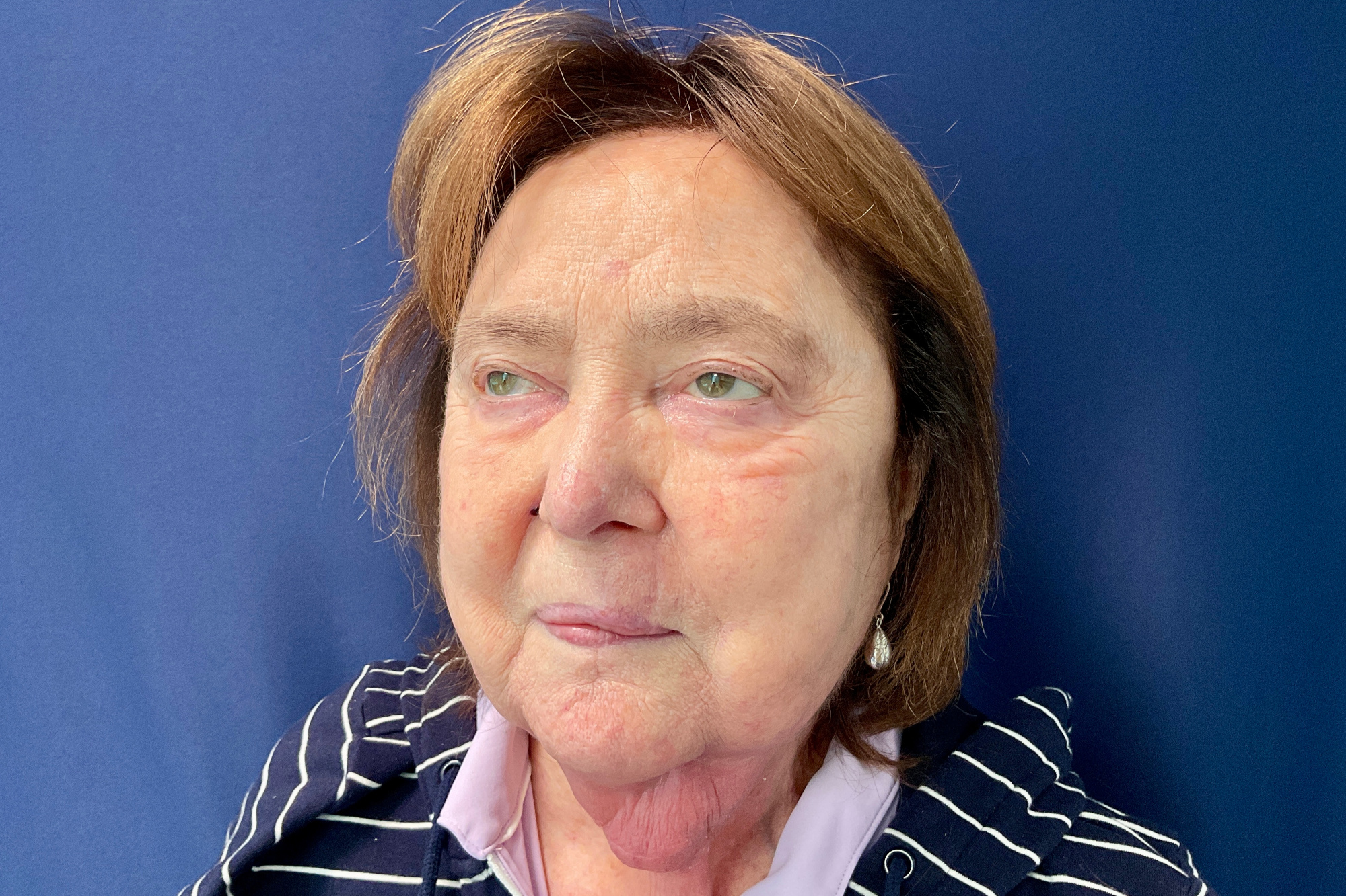 Mohs Reconstruction Patient Photo - Case 4868 - after view-1