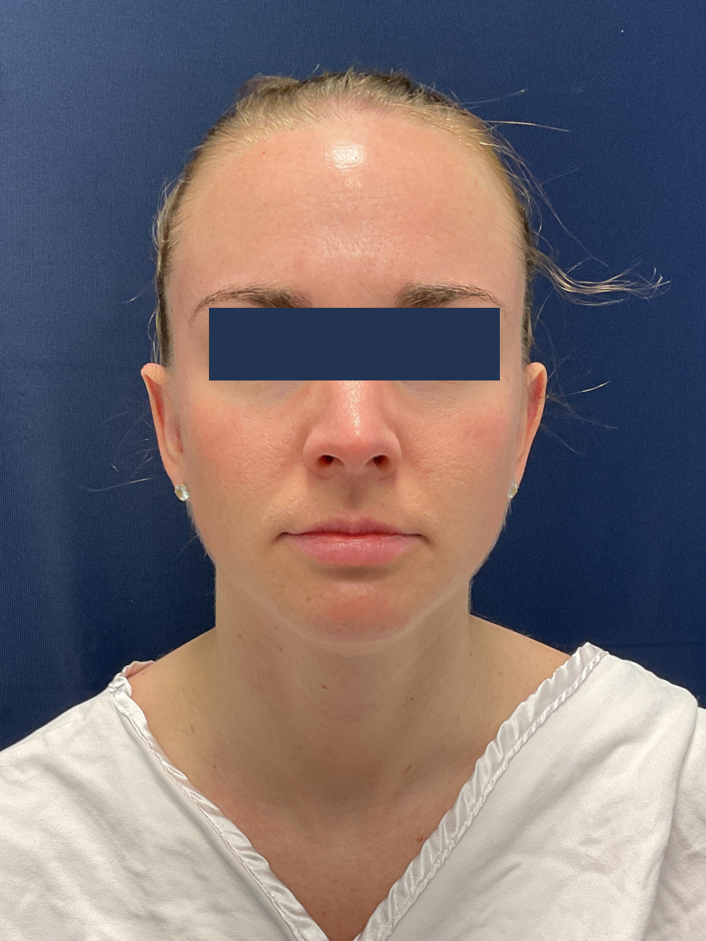 Ear Surgery (Otoplasty) Patient Photo - Case 4907 - after view