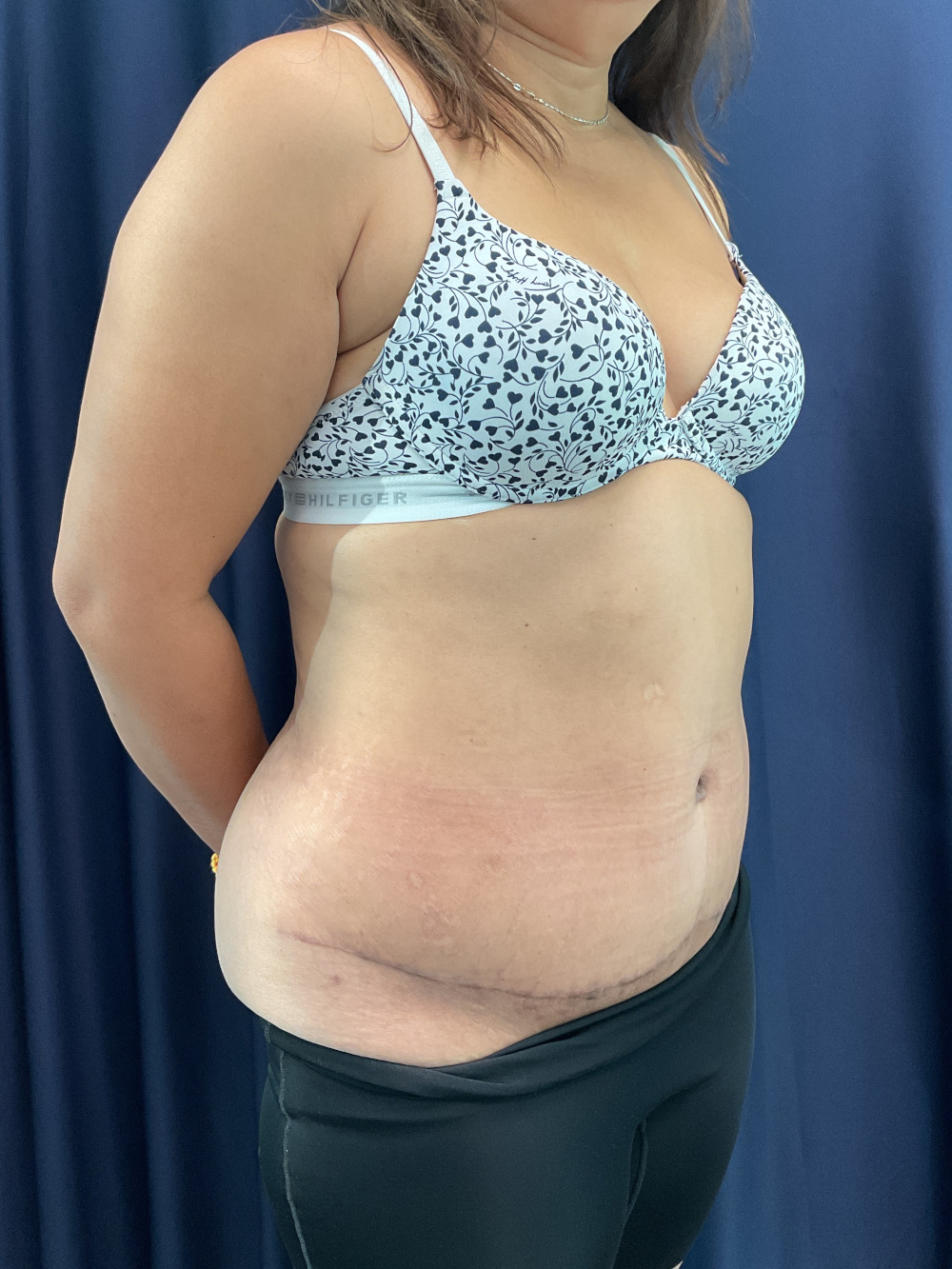 Abdominoplasty Patient Photo - Case 4922 - after view-1