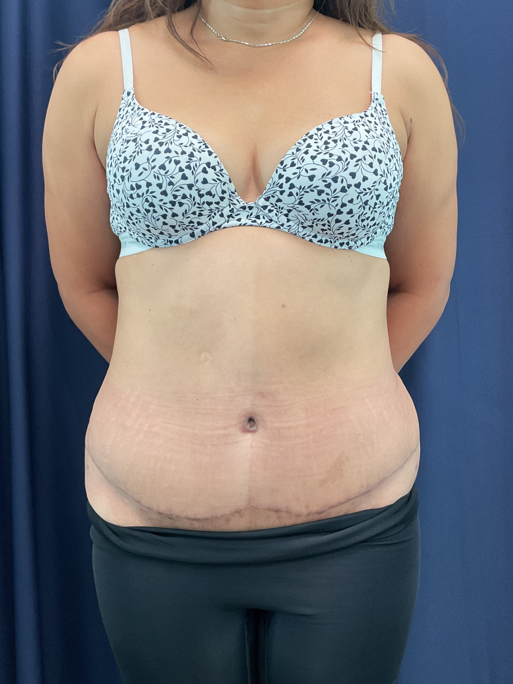Abdominoplasty Patient Photo - Case 4922 - after view