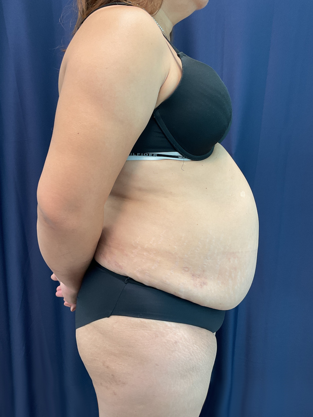 Abdominoplasty Patient Photo - Case 4922 - before view-2