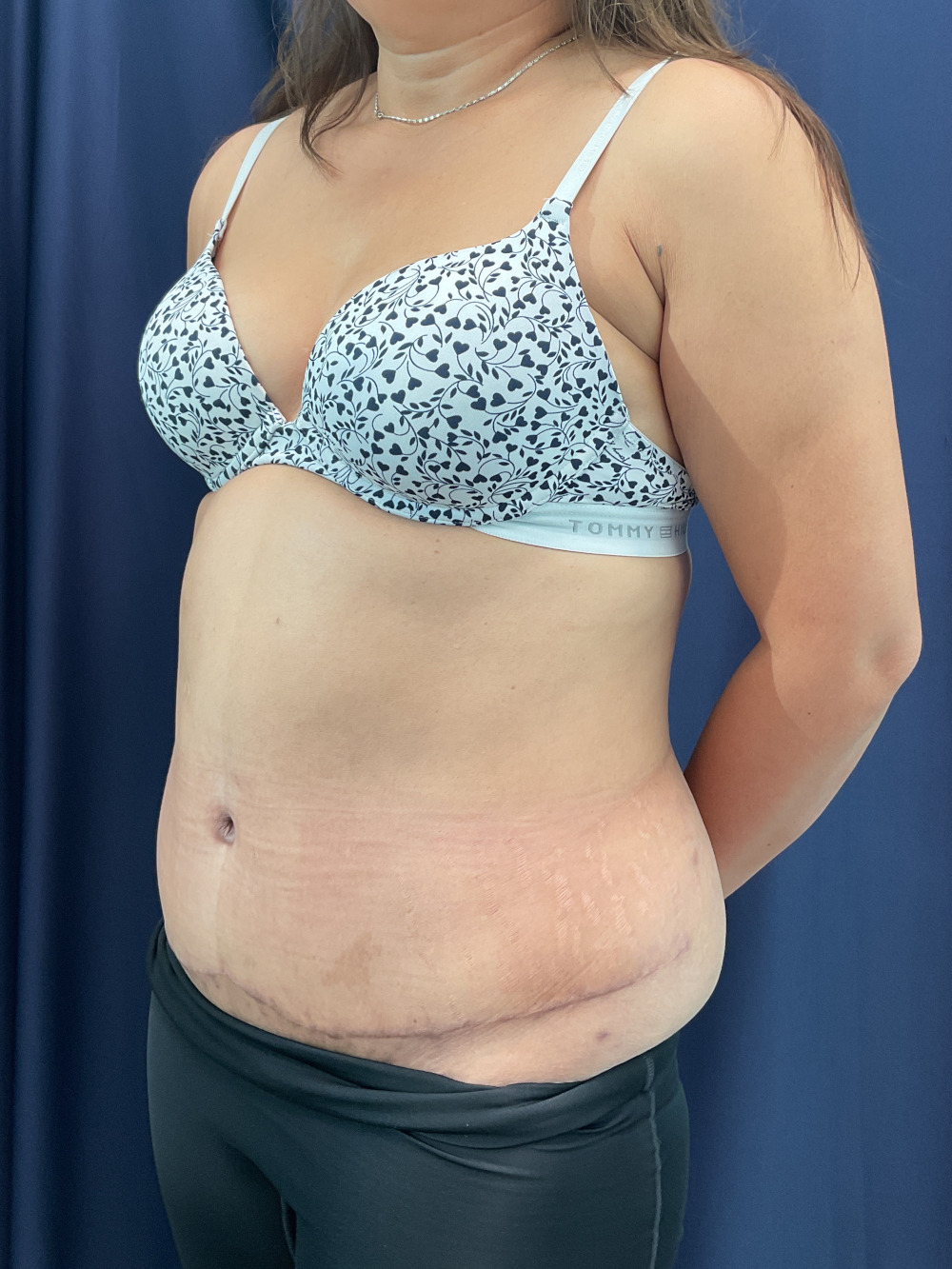 Abdominoplasty Patient Photo - Case 4922 - after view-3
