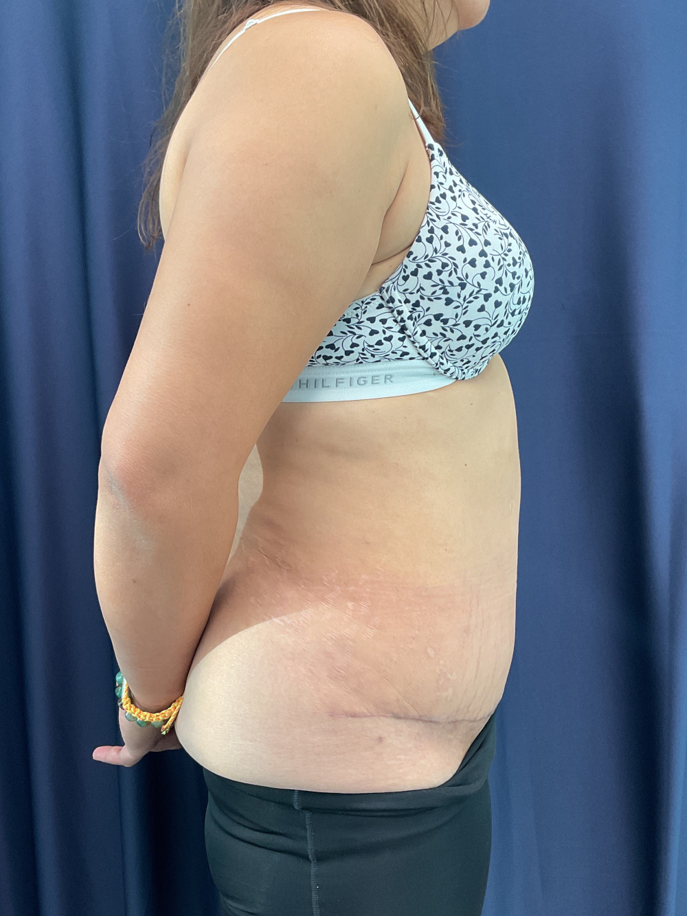 Abdominoplasty Patient Photo - Case 4922 - after view-2